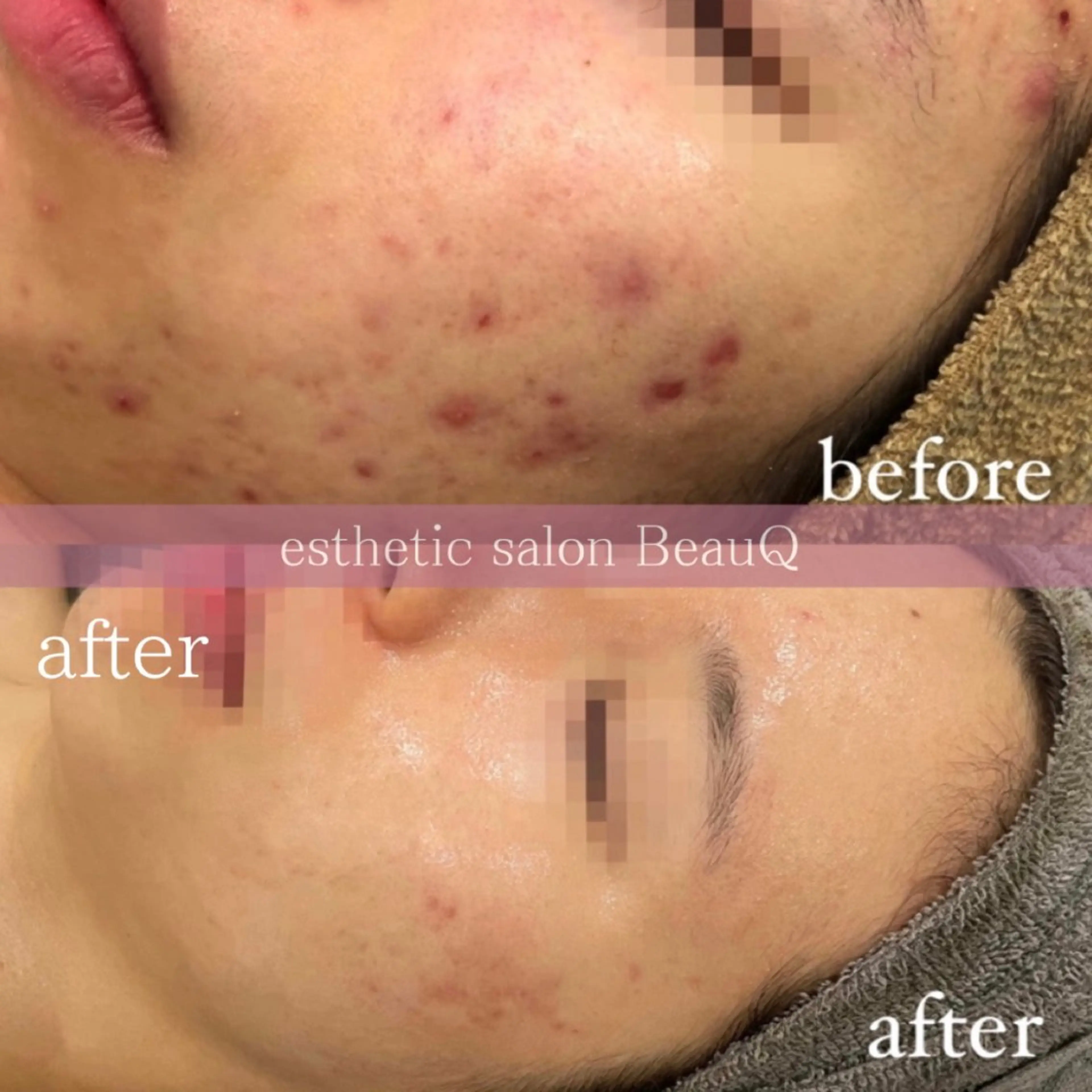 肌質改善/ブライダル 水上百華のエステ・リラクイメージ