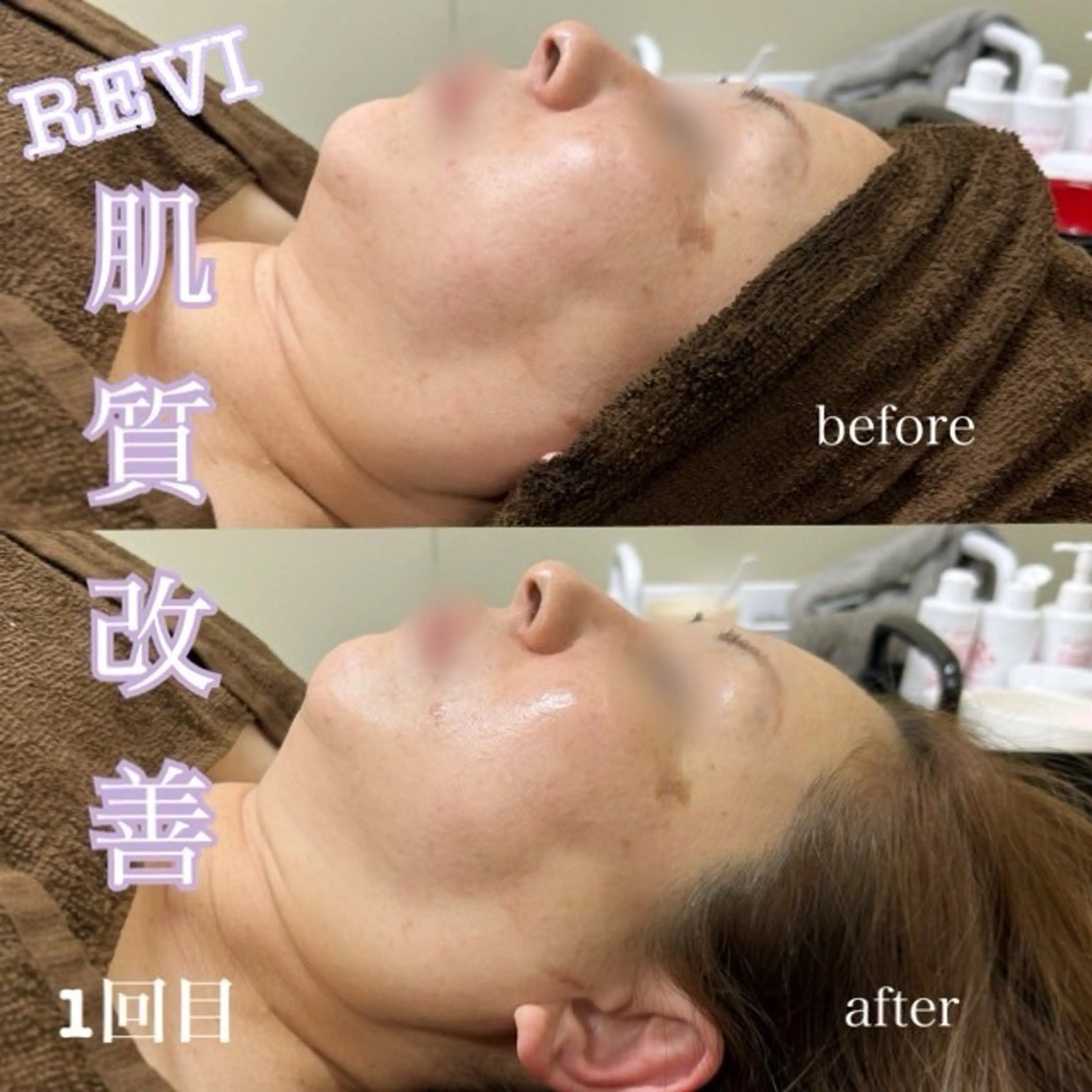 エステ 美容サロンAkazukin所属・REVI認定脱毛サ ロンAkazukinのエステ・リラクイメージ