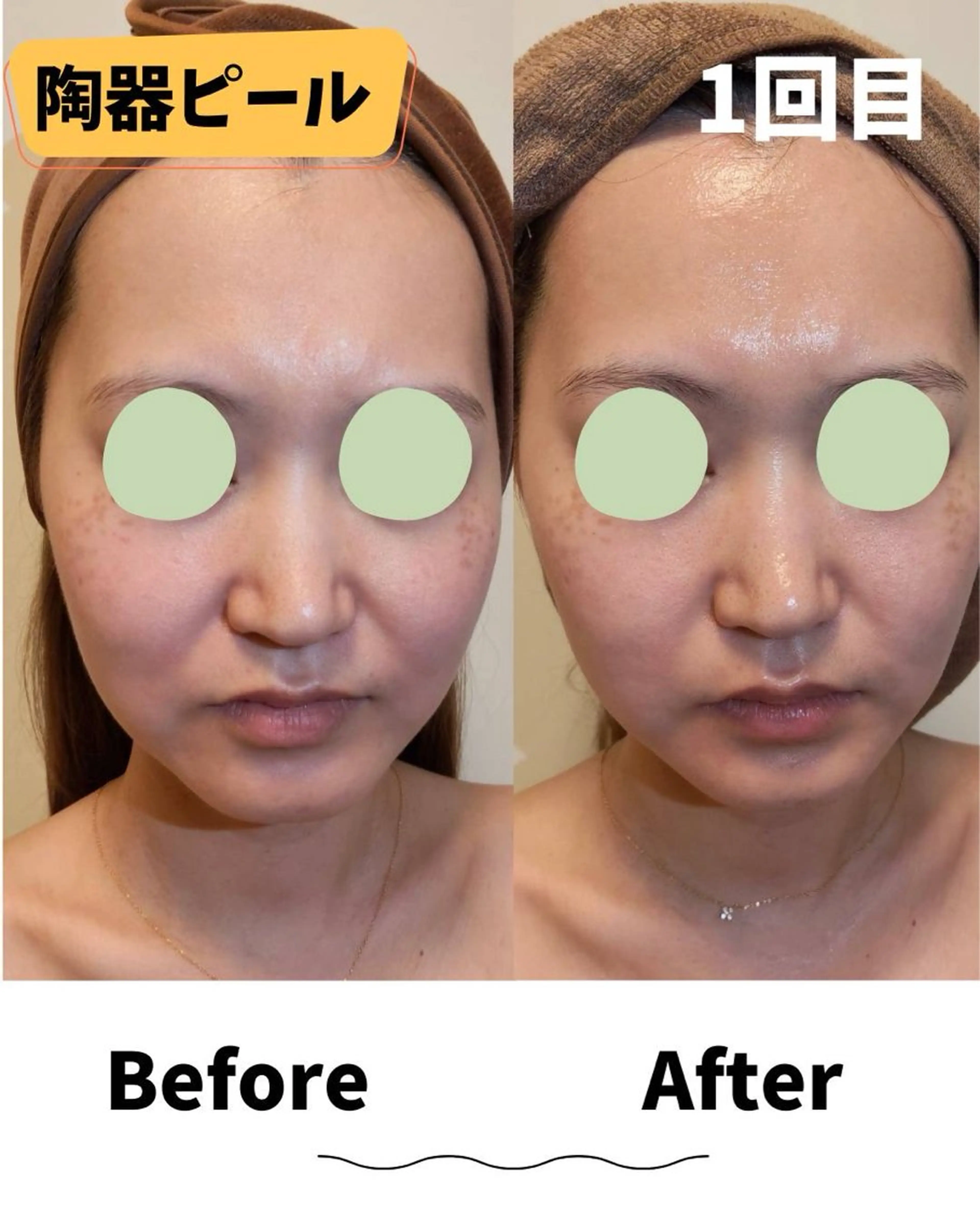 ツヤツヤ女優肌✨最高級肌育❣️【陶器ピール】顔の写真