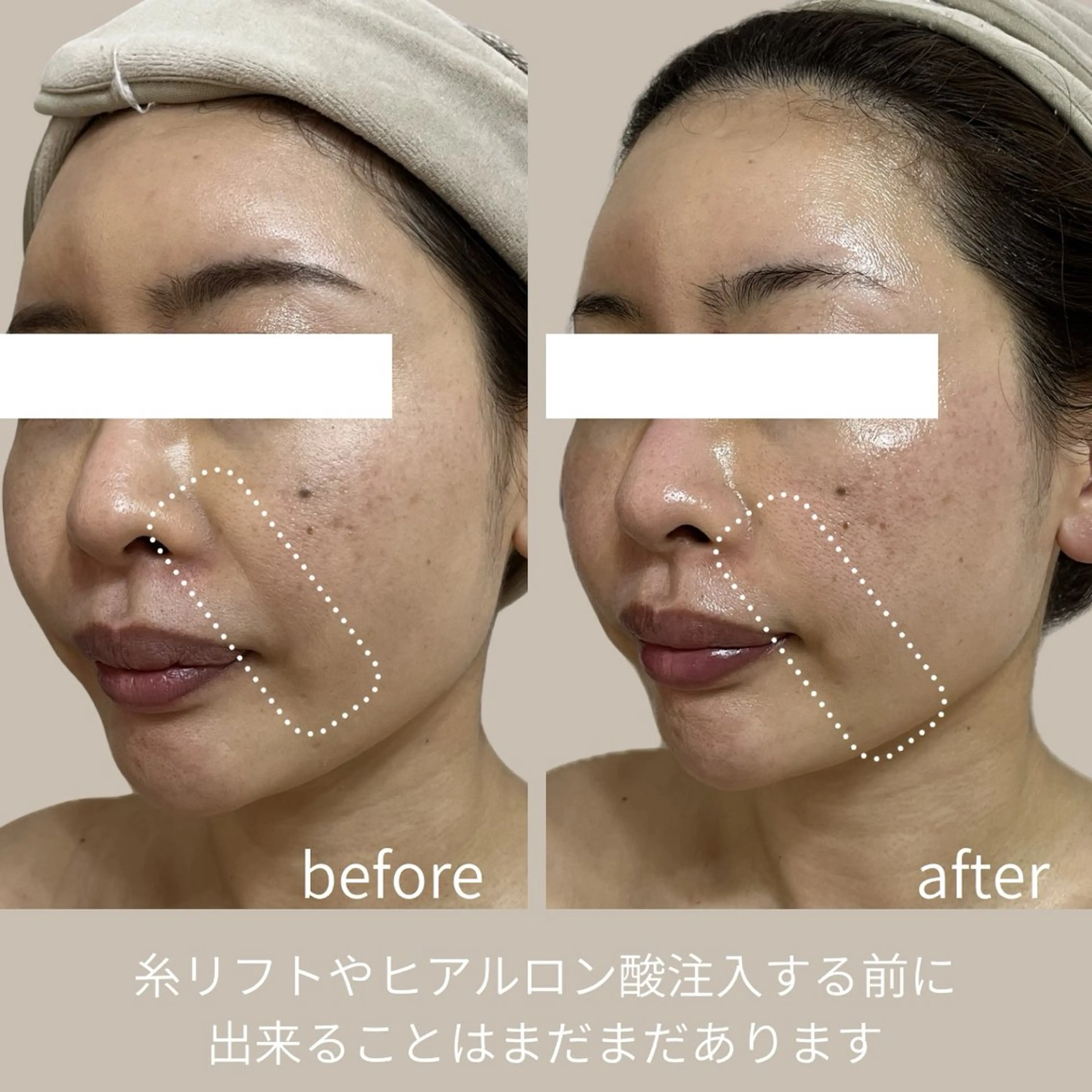 エステ リラク Total Beauty salon Bloom所属・肌質改善/ 脱毛/Bloomのエステ・リラクイメージ