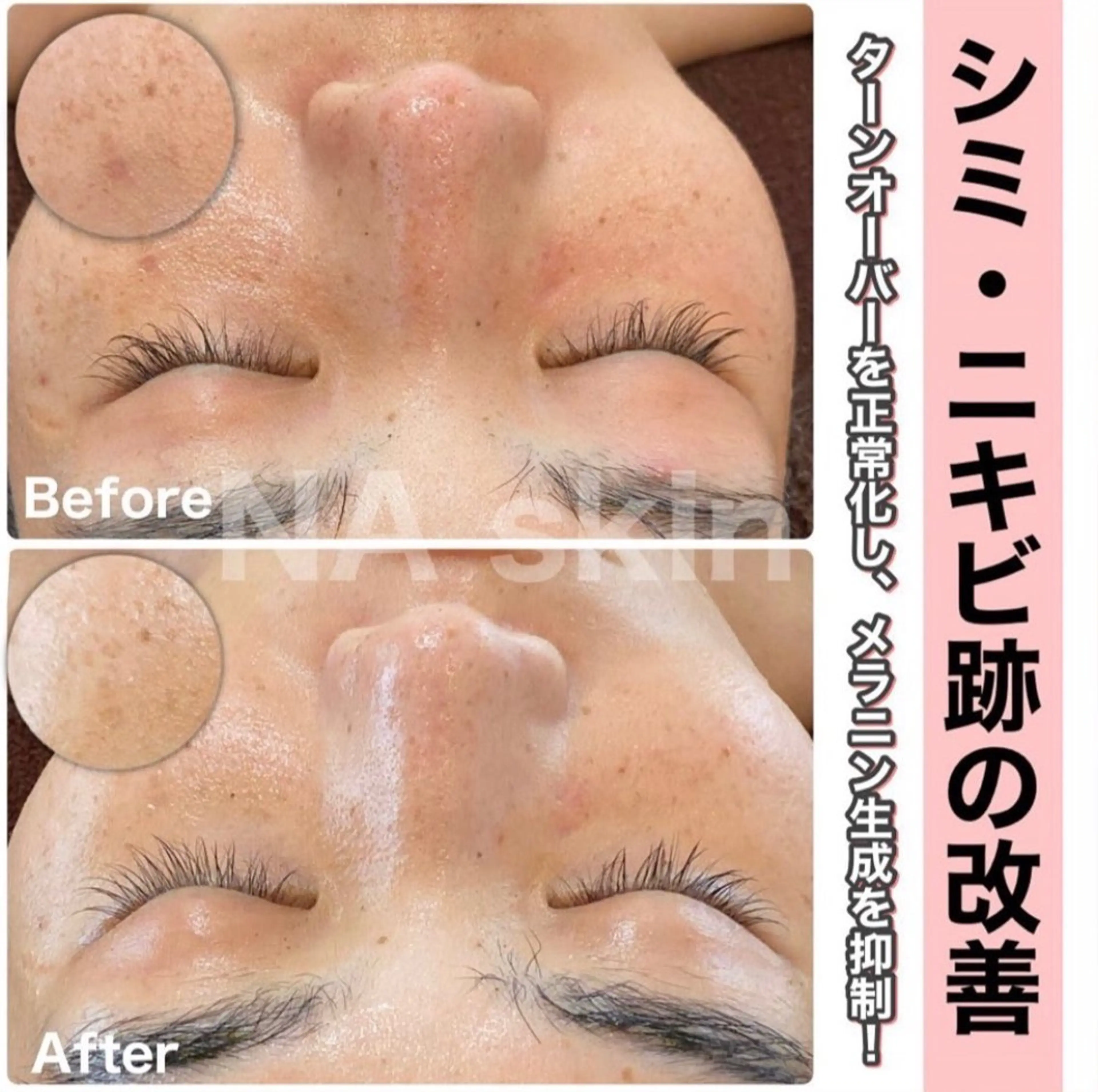 安心の看護師施術 ニキビ改善HAONのエステ・リラクイメージ