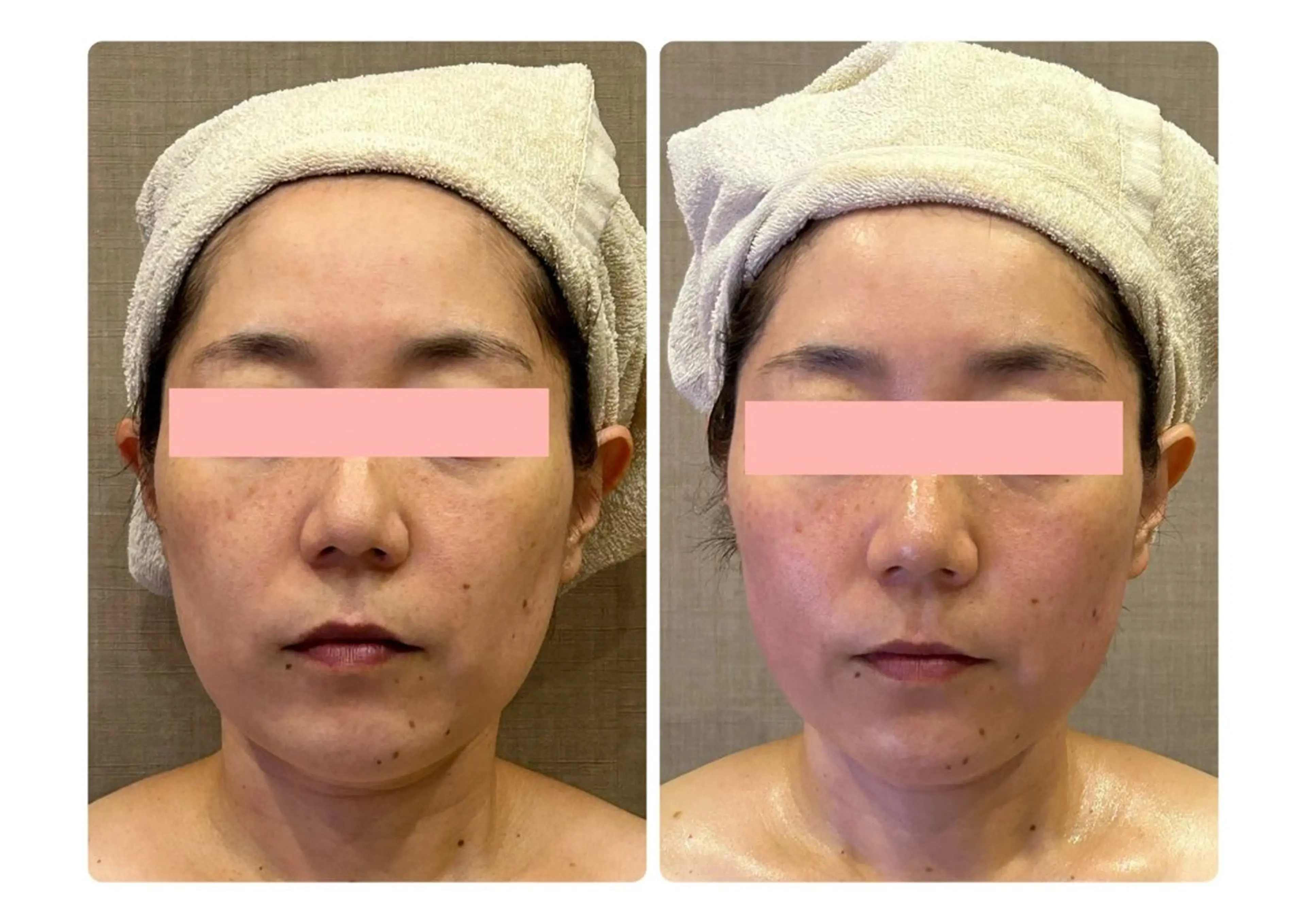 整形なし！潤ツヤ肌小顔リフトアップフェイシャルの写真