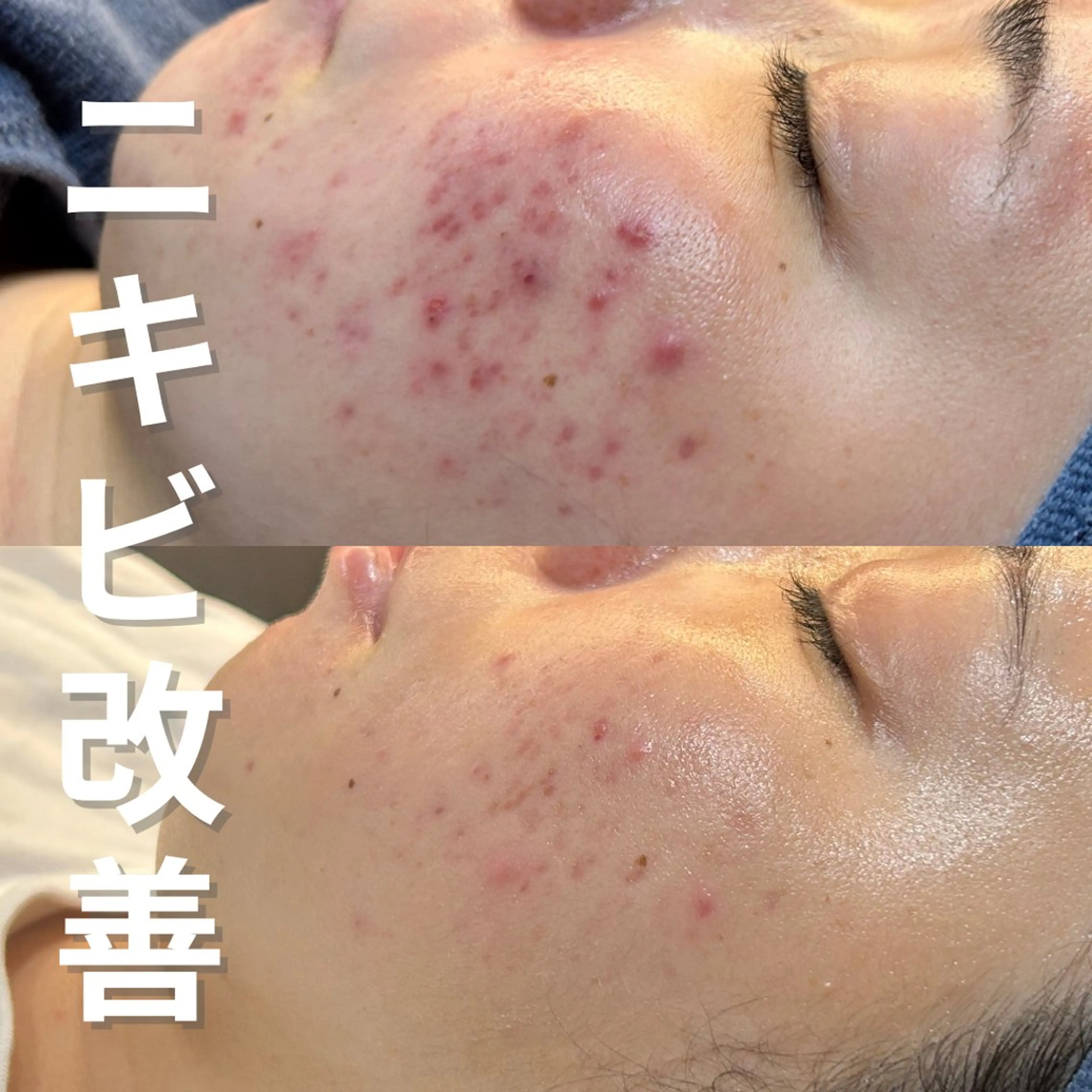 エステ ニキビ・ニキビ跡改善 leoloのエステ・リラクイメージ