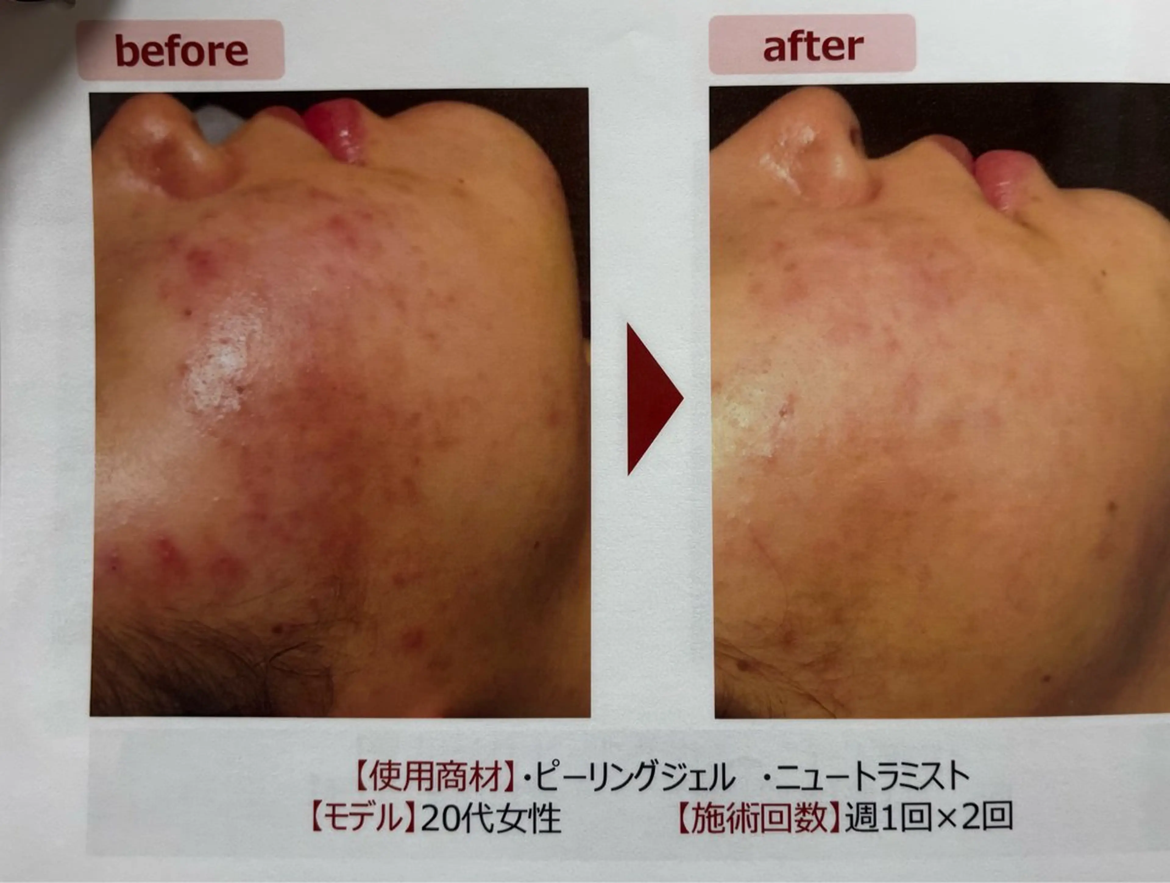 【クリニック監修　ピーリング】＋ビタミンC導入付きの写真