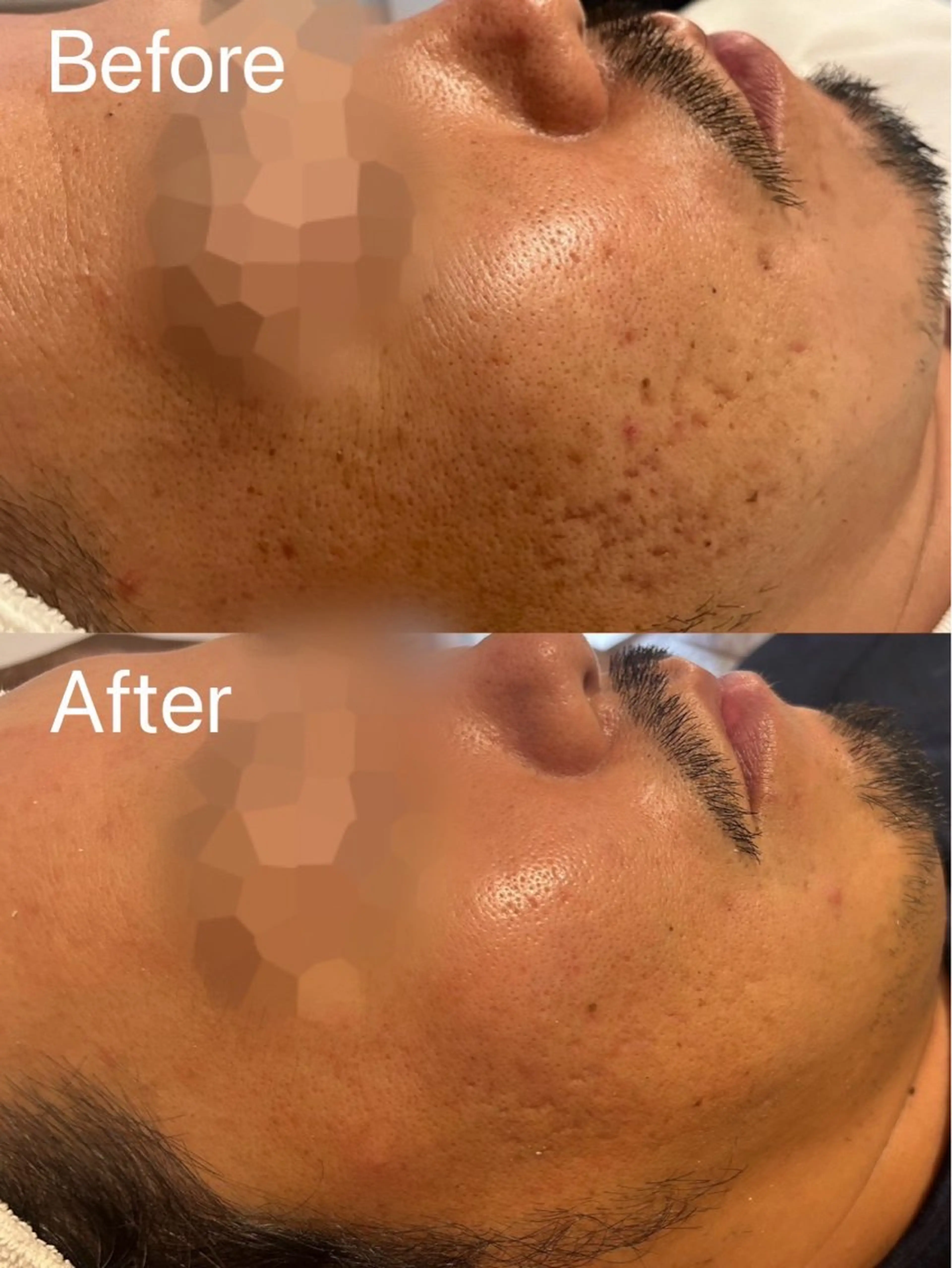 エステ 毛穴/ハーブピーリング 韓国肌管理Belle 高槻所属・韓国肌管理 Belleのエステ・リラクイメージ