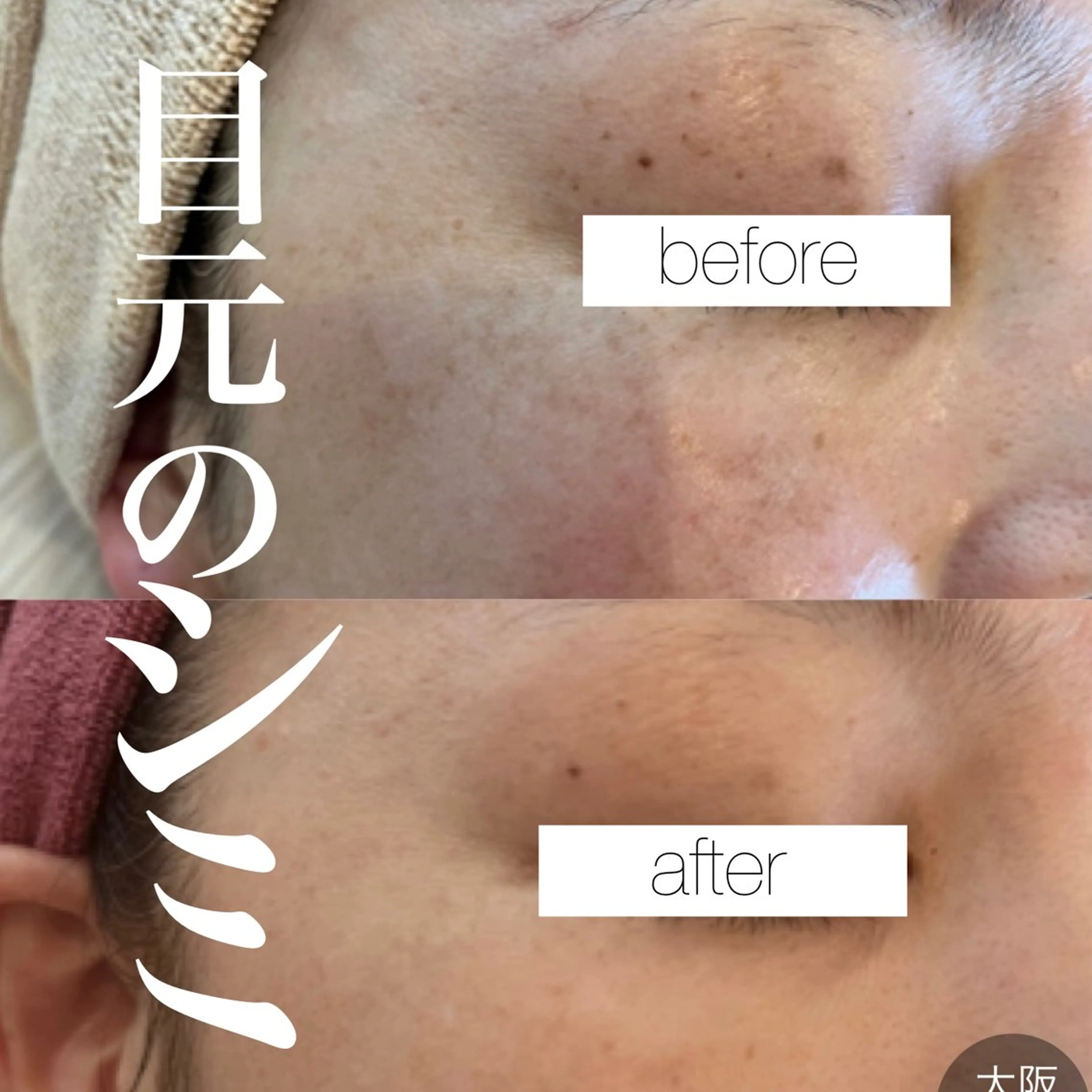 【しみ毛穴専門店】beautysalon Ankh所属・しみ毛穴専門店 Ankh 平田のエステ・リラクイメージ