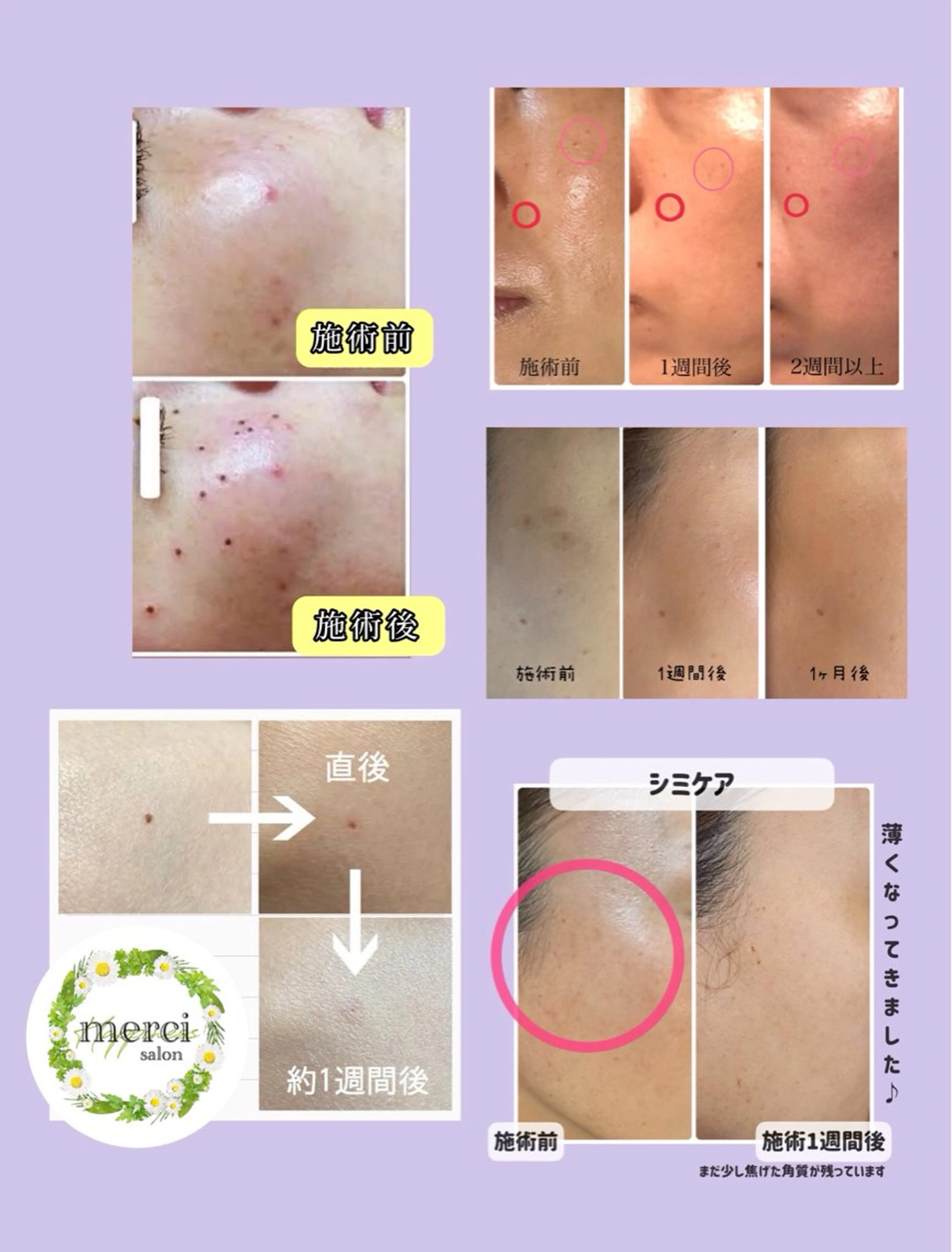 シミ・イボケア1個¥500✨こちらのカウンセリング¥0が必須⭕️の写真