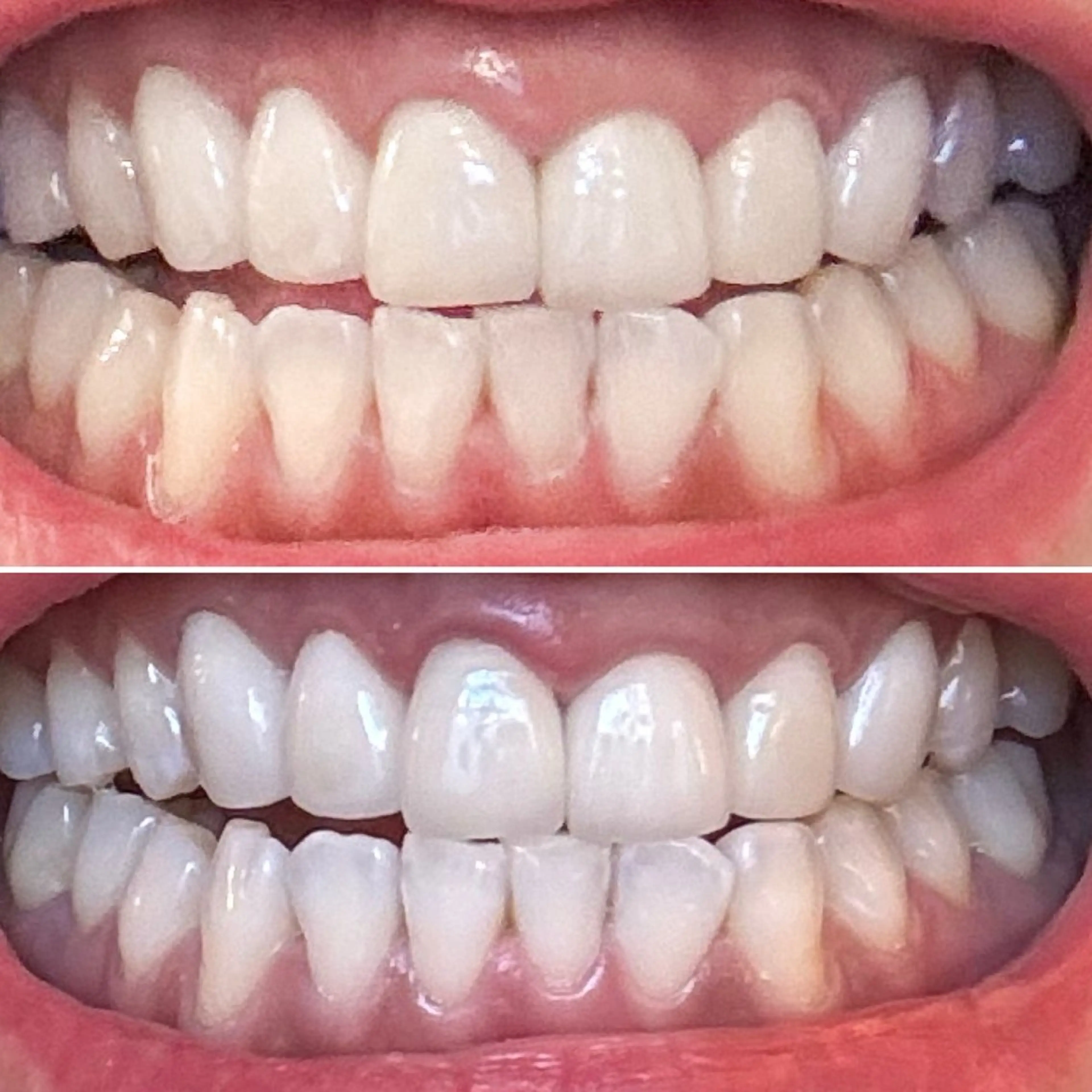 【ダブル照射】オーラルケア🦷✨15分＋15分の2回照射で30分❣メンズも大歓迎♪の写真