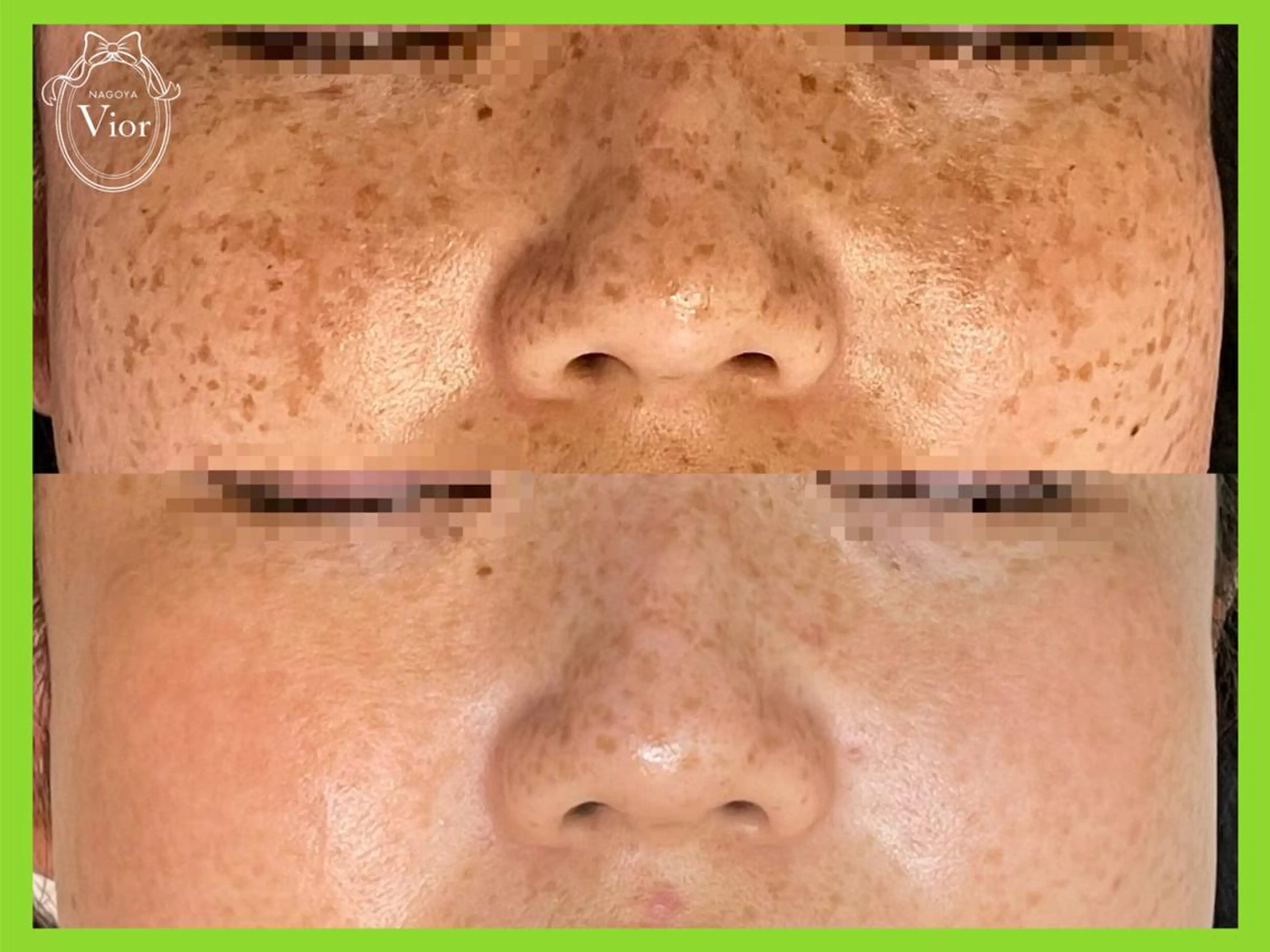 エステ 栄 VIO Rのエステ・リラクイメージ