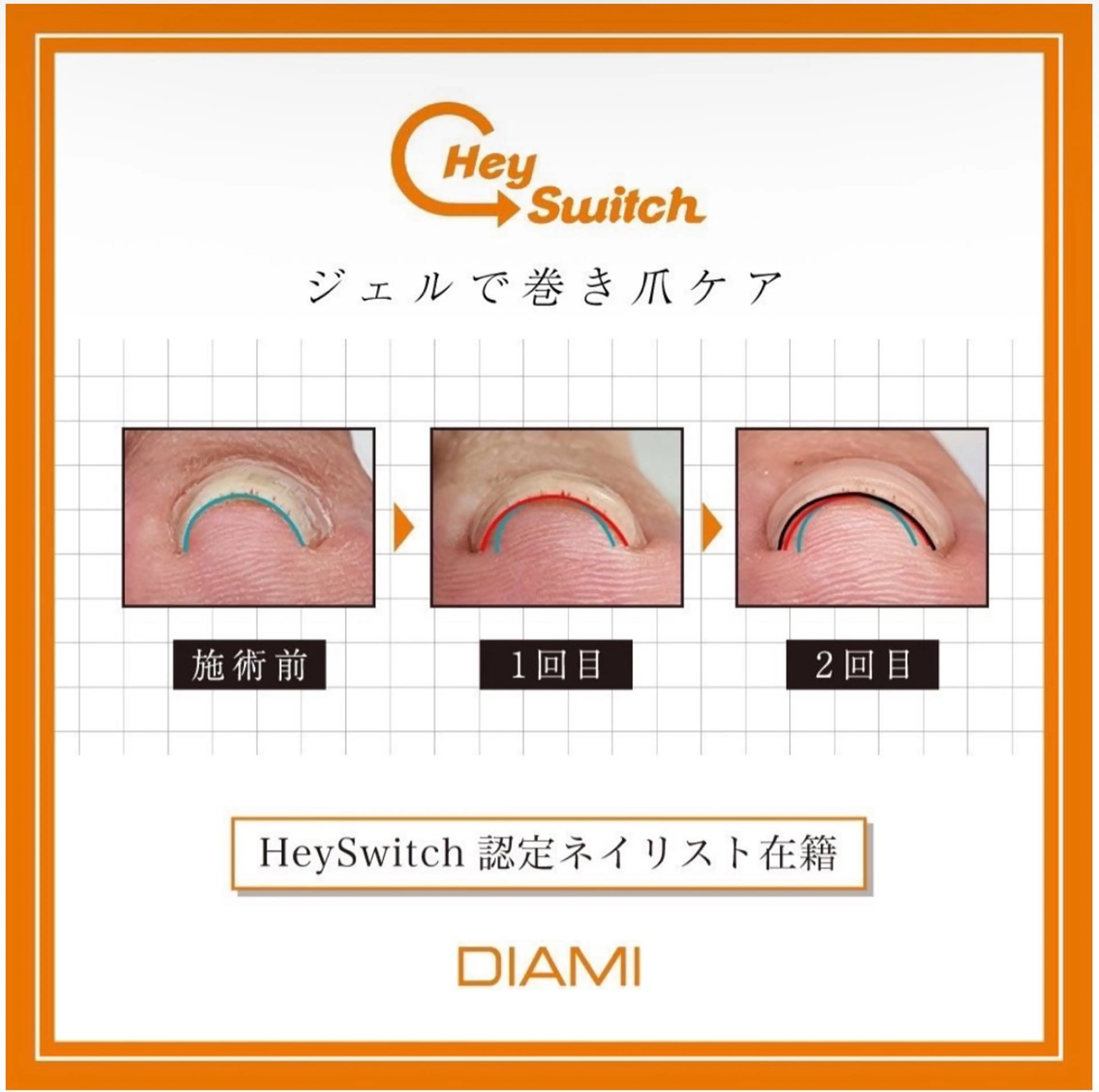 【フット】巻き爪ケア1本¥5500→¥3300の写真