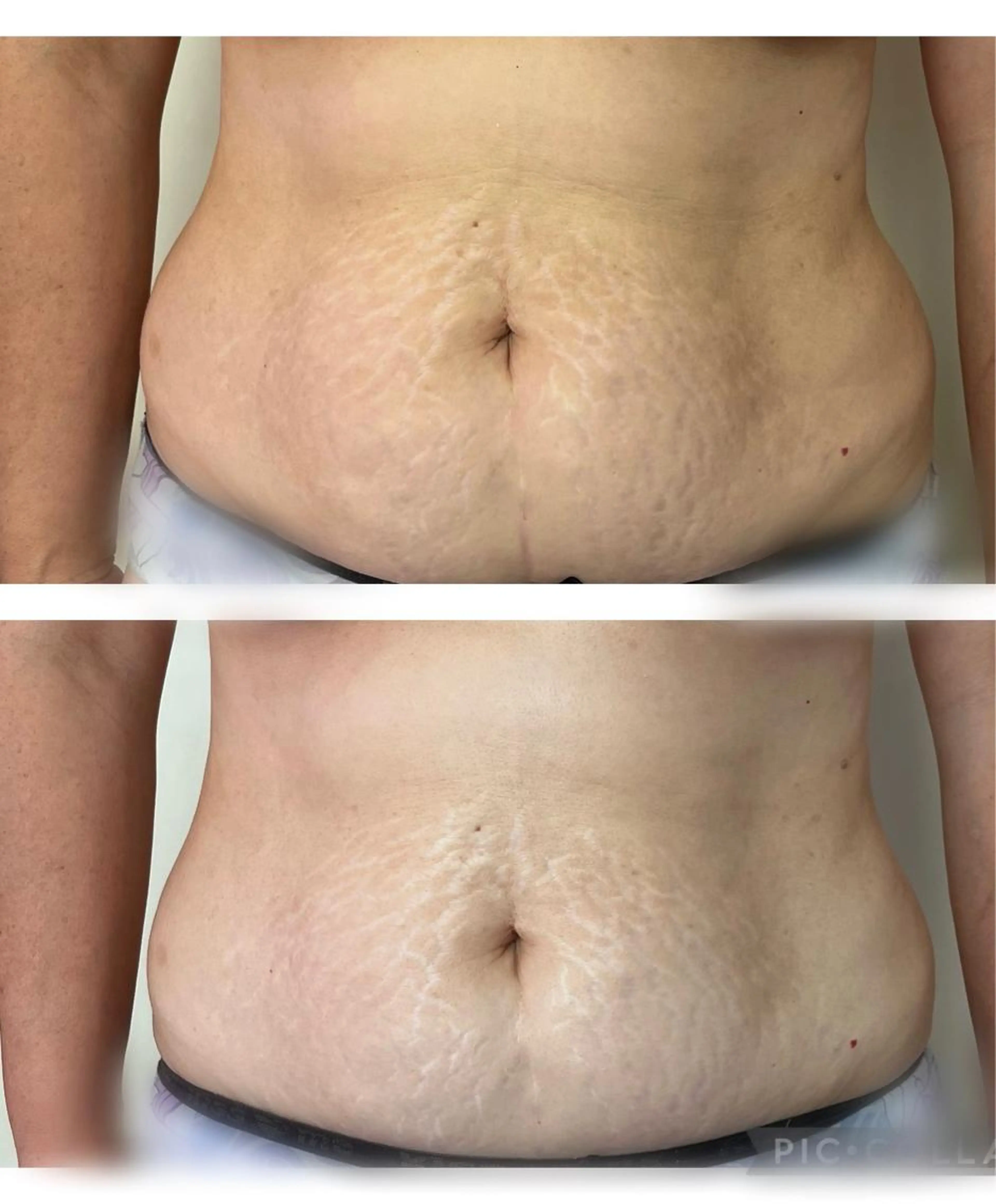 【脂肪撃退!】全身60分どこでも当て放題!脂肪&セルライトにアプローチ✨キャビテーション&ラジオ波&EMS(筋肉運動)の写真