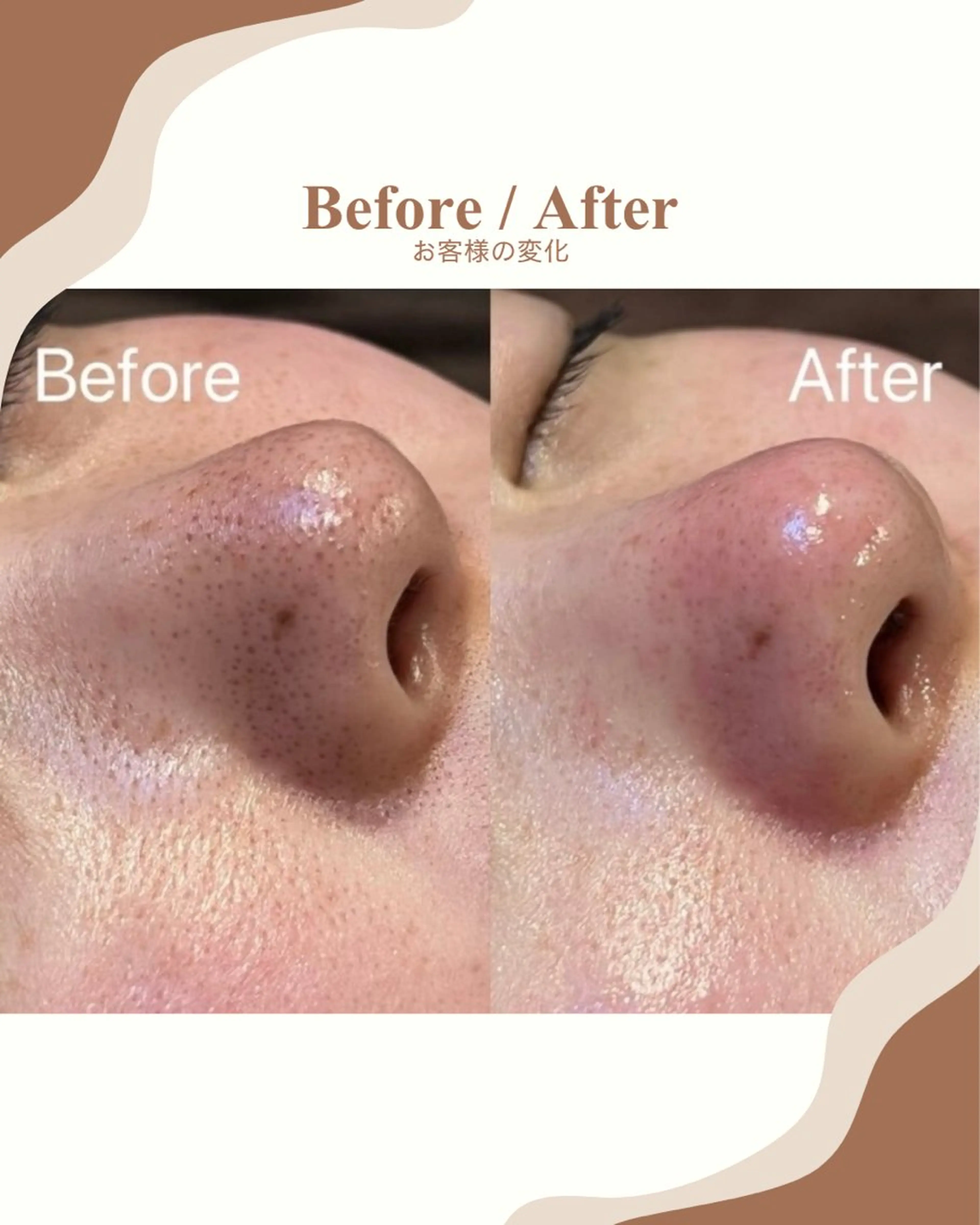 毛穴洗浄ハイドラフェイシャル《ビタミン導入付き》の写真