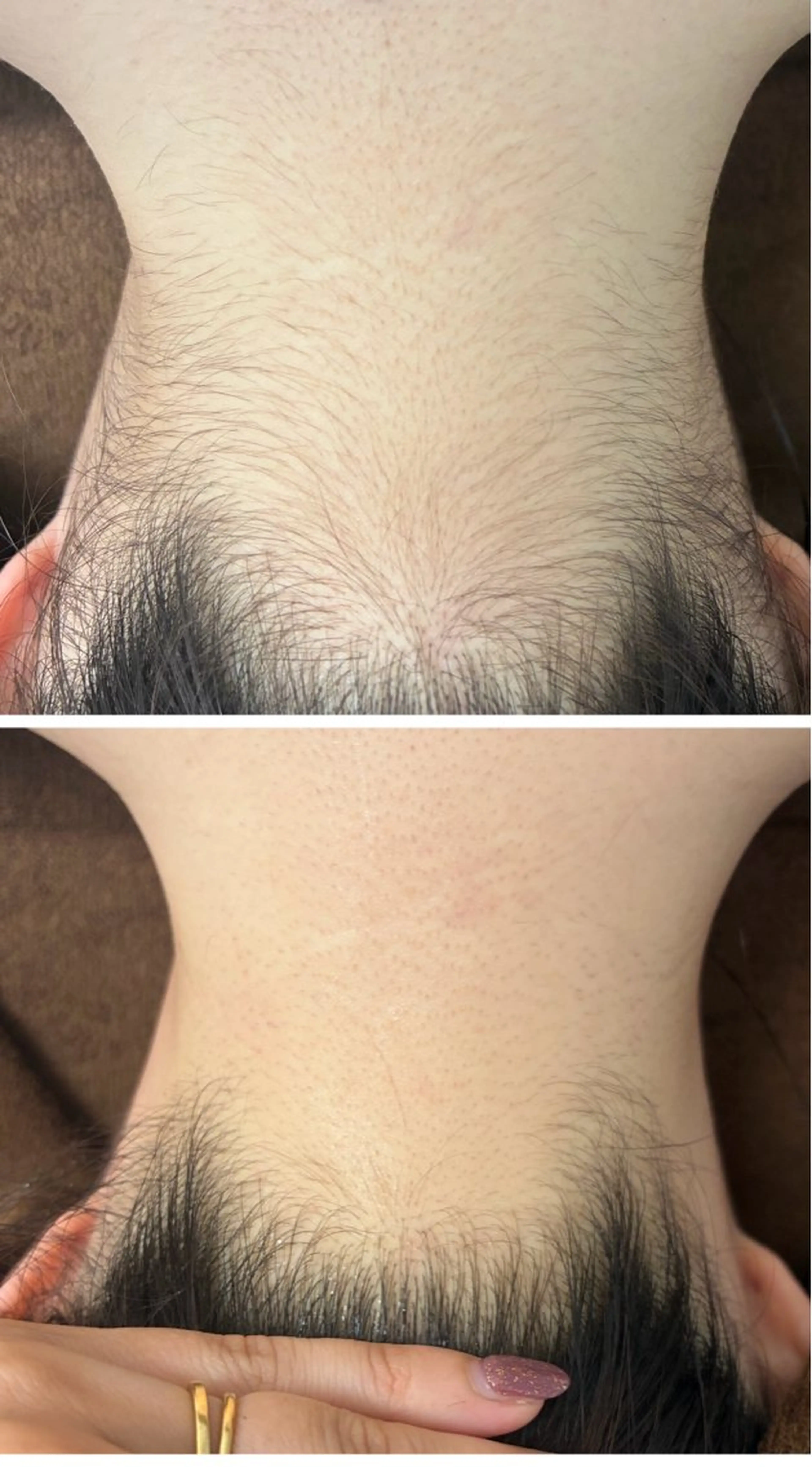 【女性人気】うなじ＋背中上脱毛〈シェービング込〉の写真