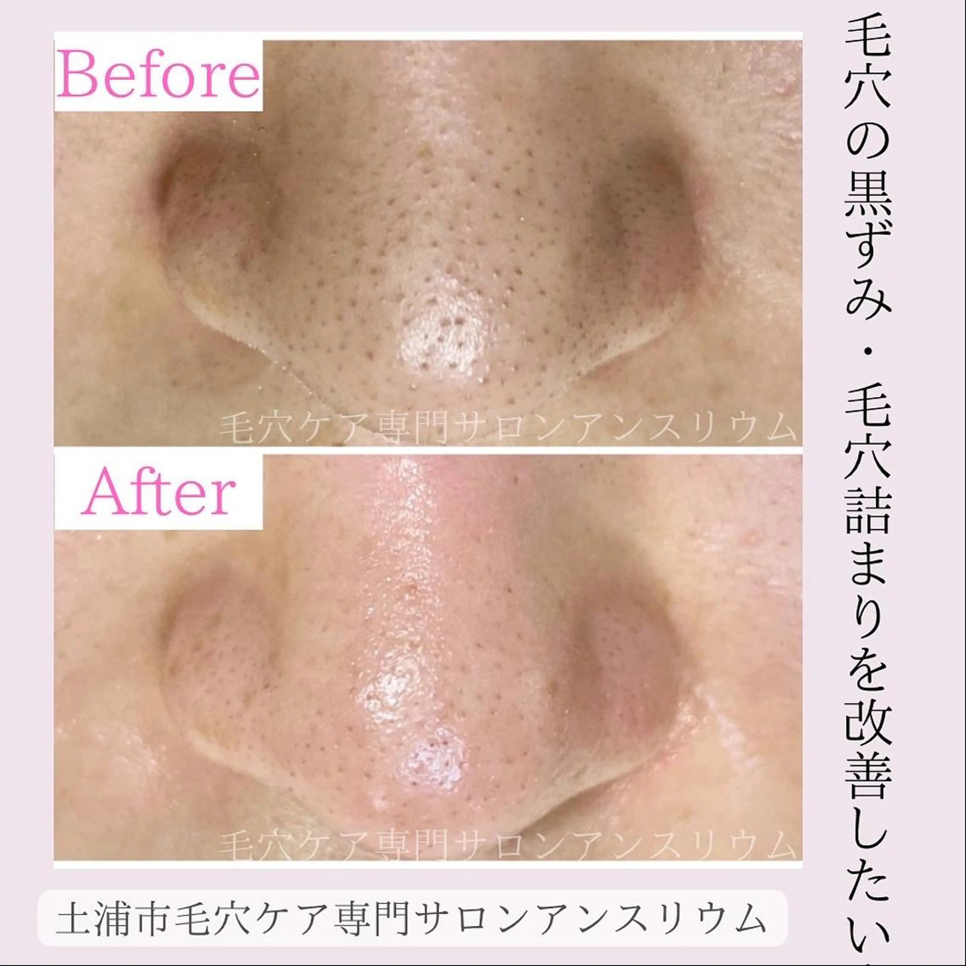 毛穴ケア専門サロンアンスリウム所属・茨城土浦 つくば毛穴 ケア専門サロンのエステ・リラクイメージ