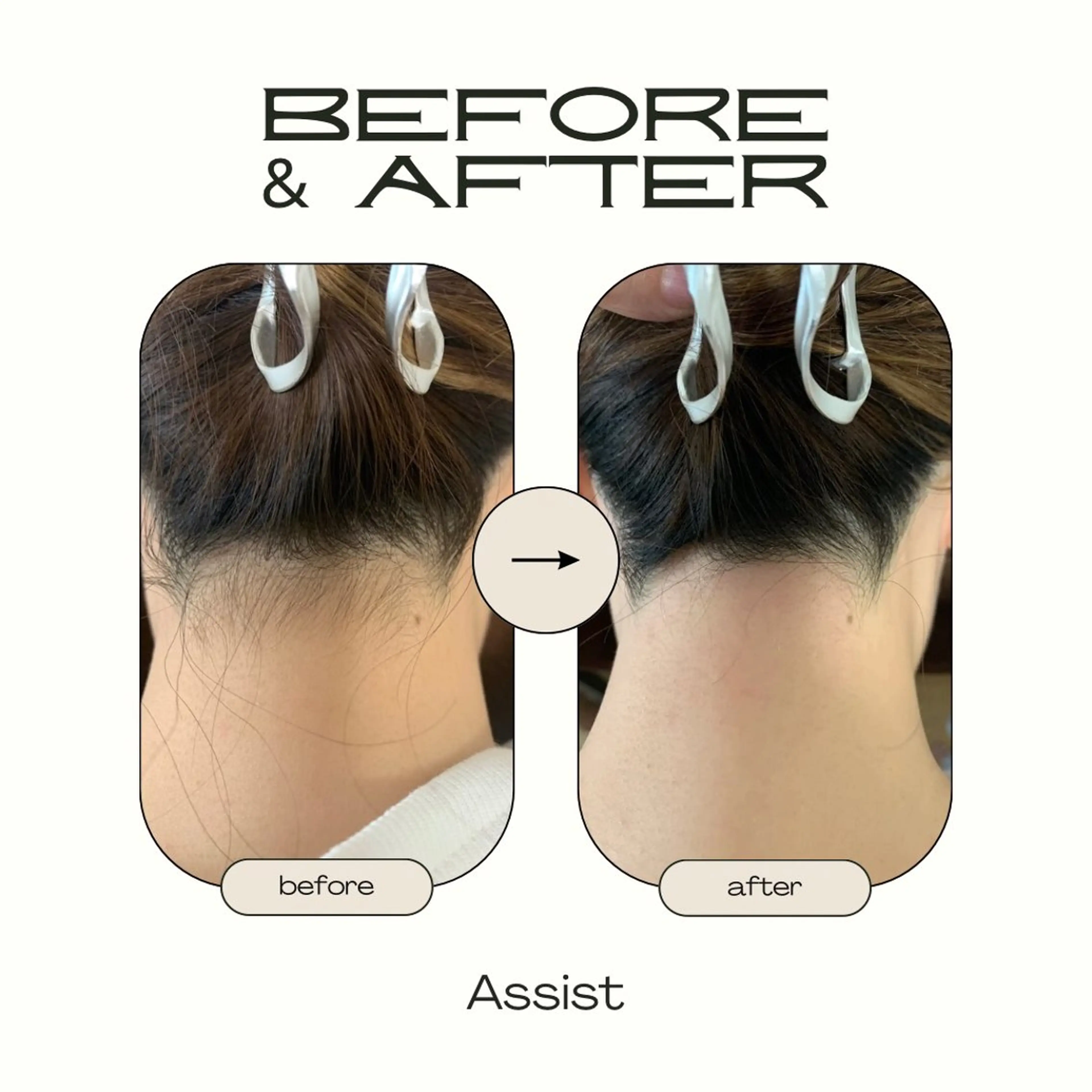 【脇orうなじorデコルテorもみあげ】ワックス脱毛の写真