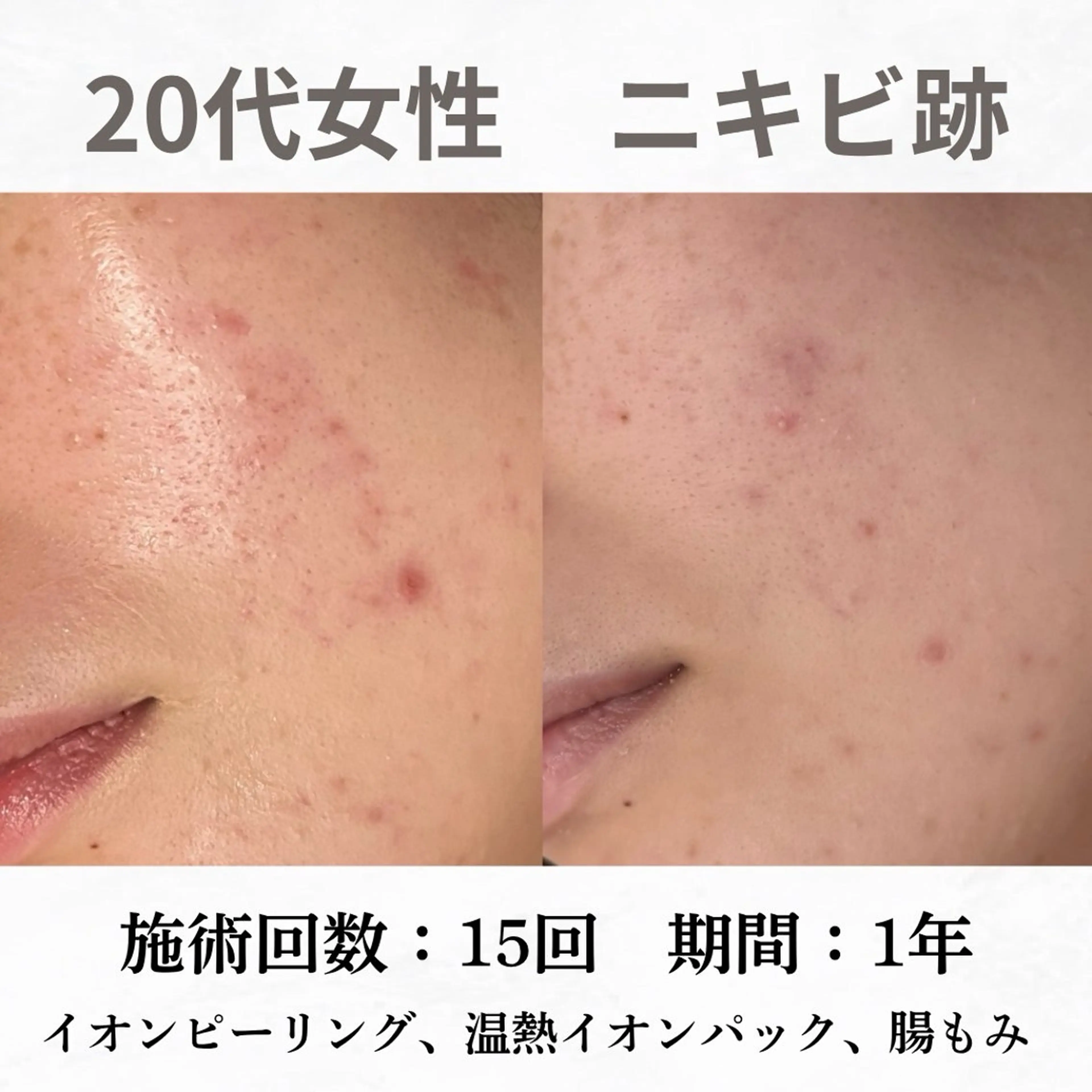 重度ニキビ専門🌷 ダウンタイムなしのエステ・リラクイメージ