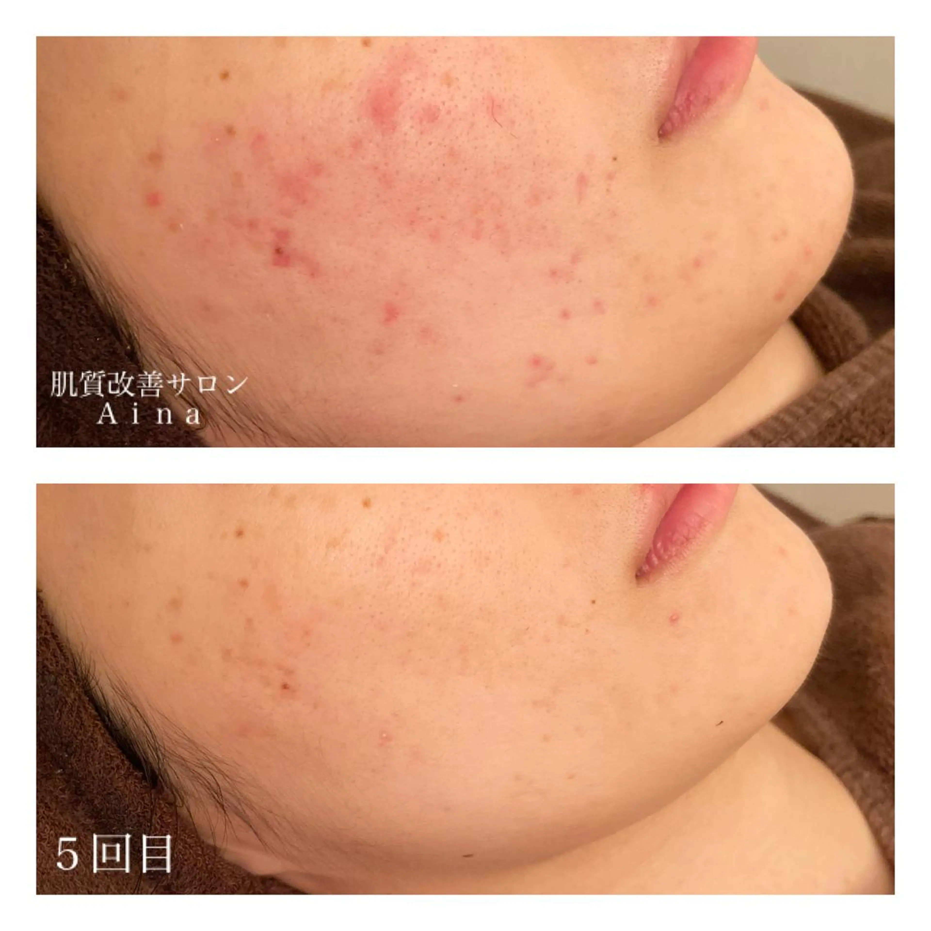 ミディアム カラー パーマ ヘアアレンジ メンズ ネイル マツエク・マツパ 卒業式のヘアスタイル 卒業式 赤色 ニキビ跡専門サロン Ａｉｎａのエステ・リラクイメージ