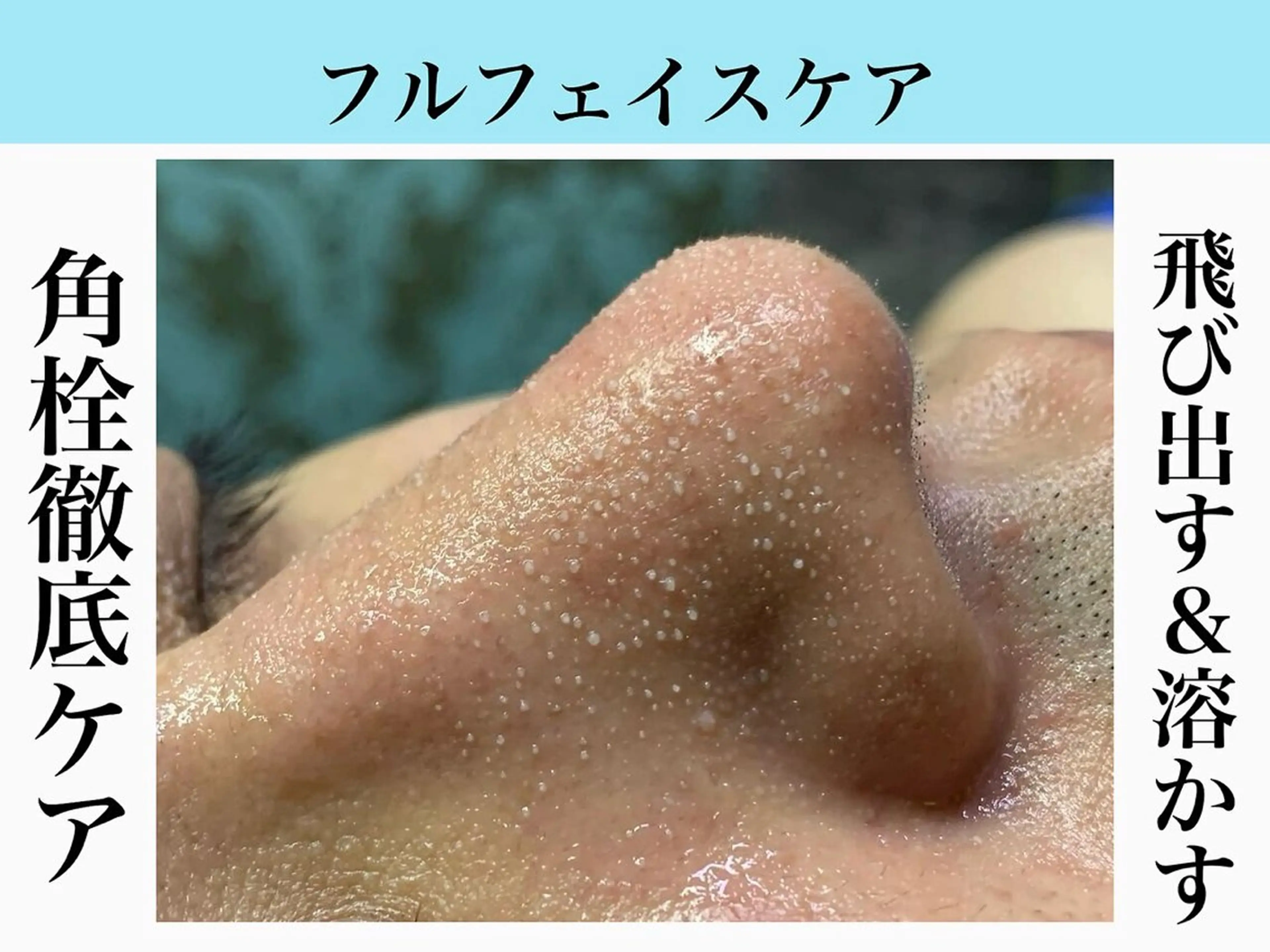 溶ける角栓【毛穴吸引】引き締めパック&鎮静パック付き♪フルフェイス今だけ¥6980💆‍♂️の写真