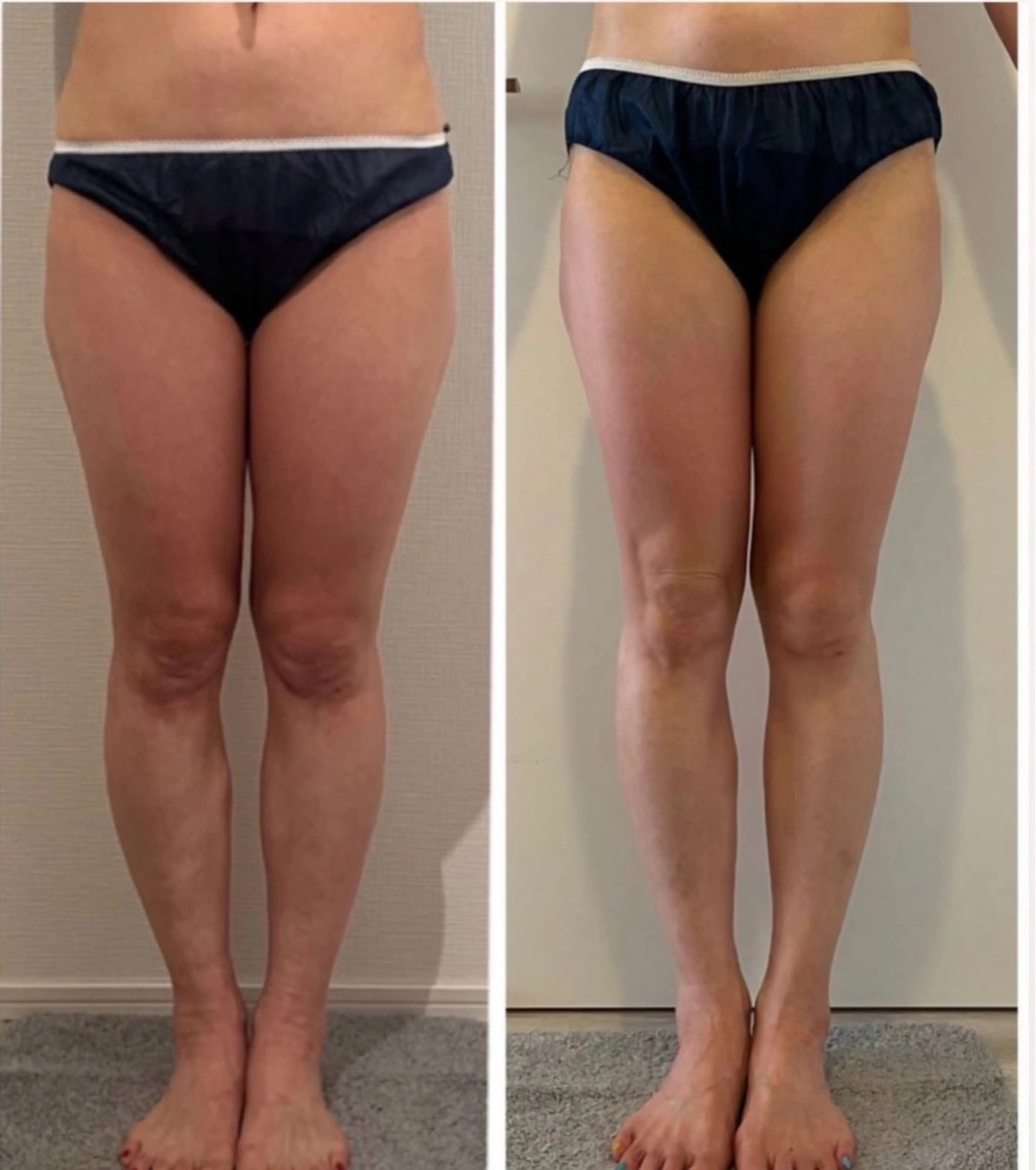 お急ぎダイエット‼️セル撃退🔥🪠マシンケアorオールハンド部位が選べる半身痩身コース👙❤️の写真