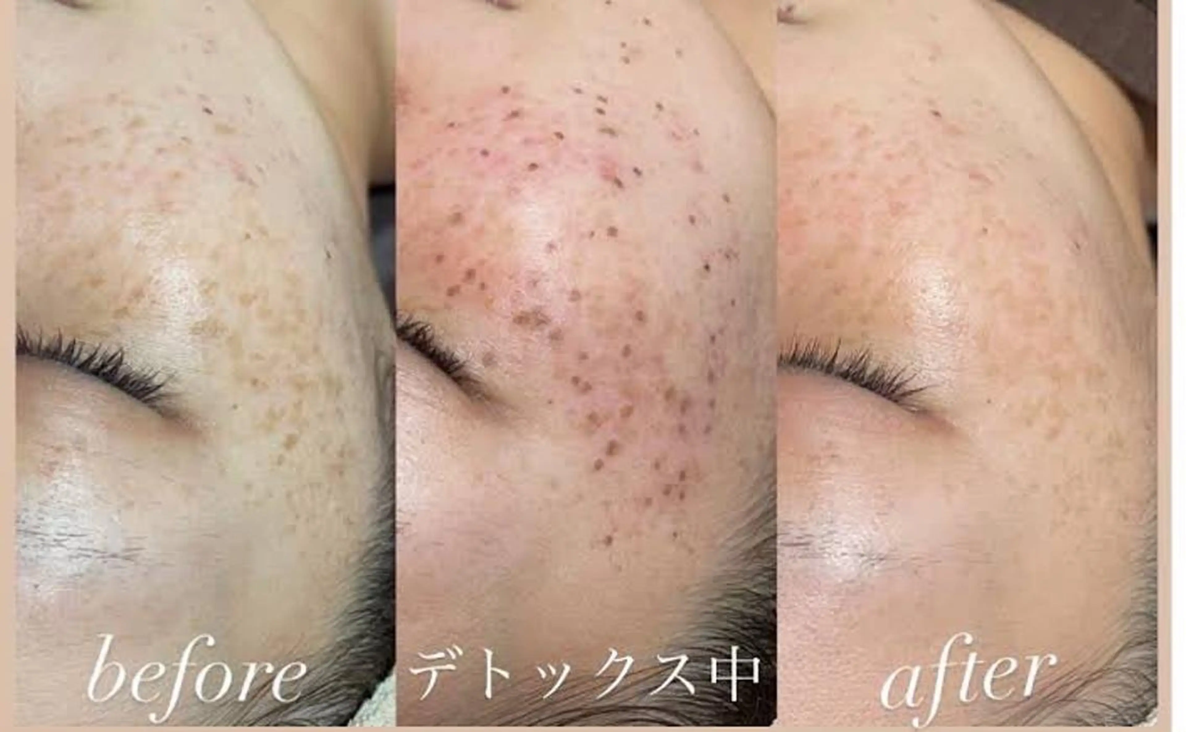 セルフシミケアコース(30分間取り放題)の写真