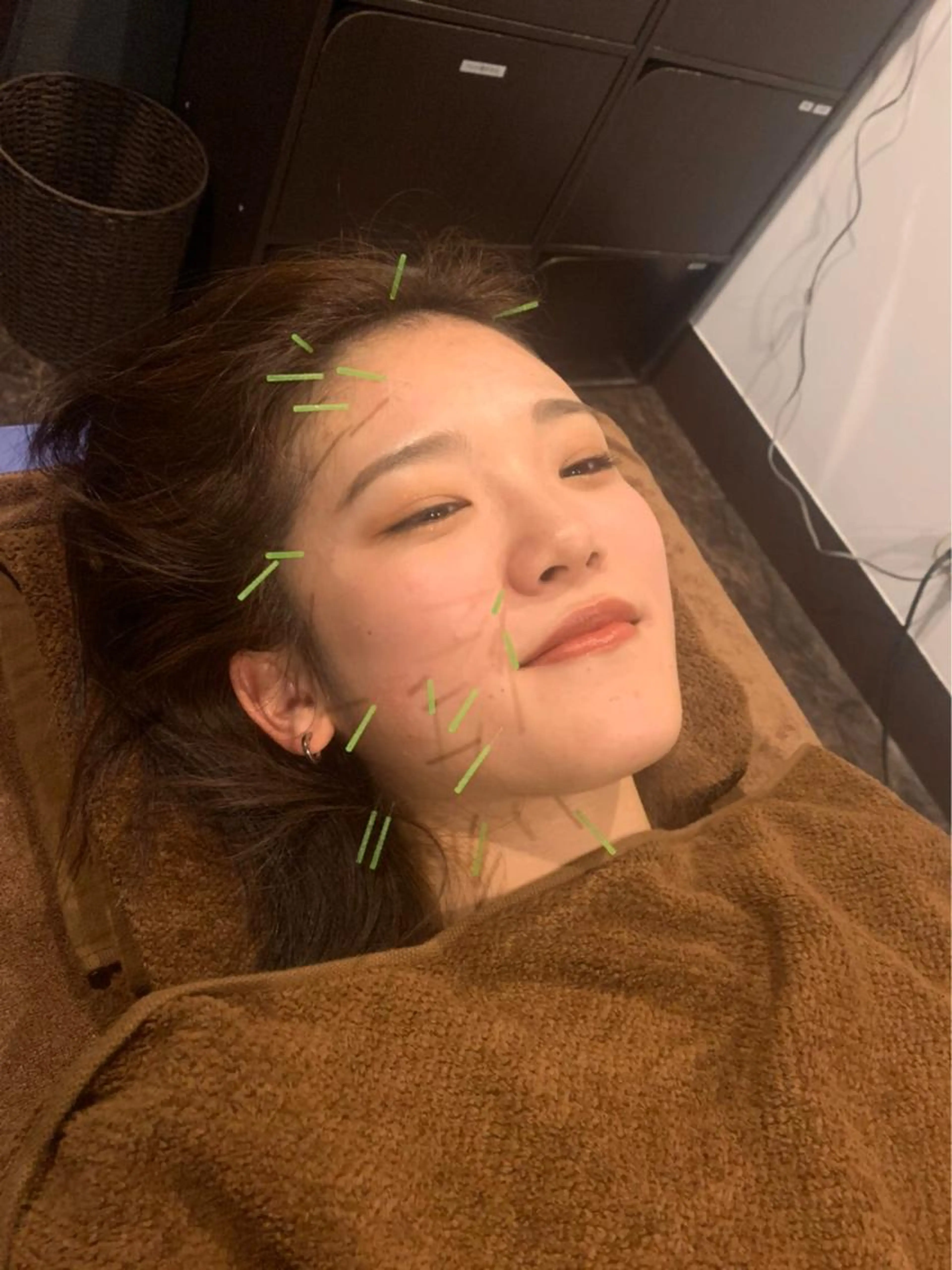 ミニモ限定⭐️顔のみ美容鍼⭐️⭐️【U24学割】口コミ❣️🌟1日5名限定⭐️の写真