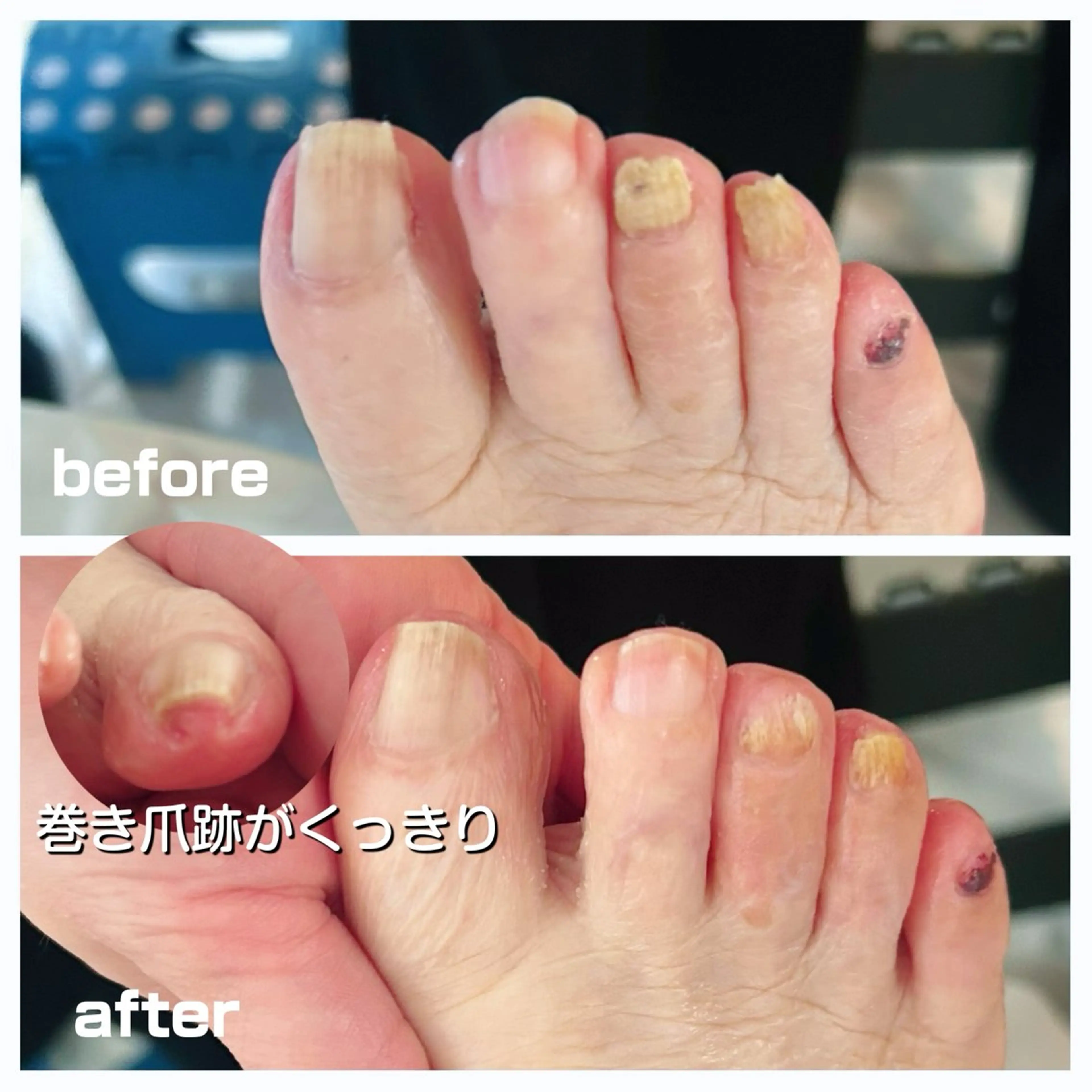 その他 巻き爪フットケアサロンKotori所属・フットケアサロン Kotoriのその他イメージ