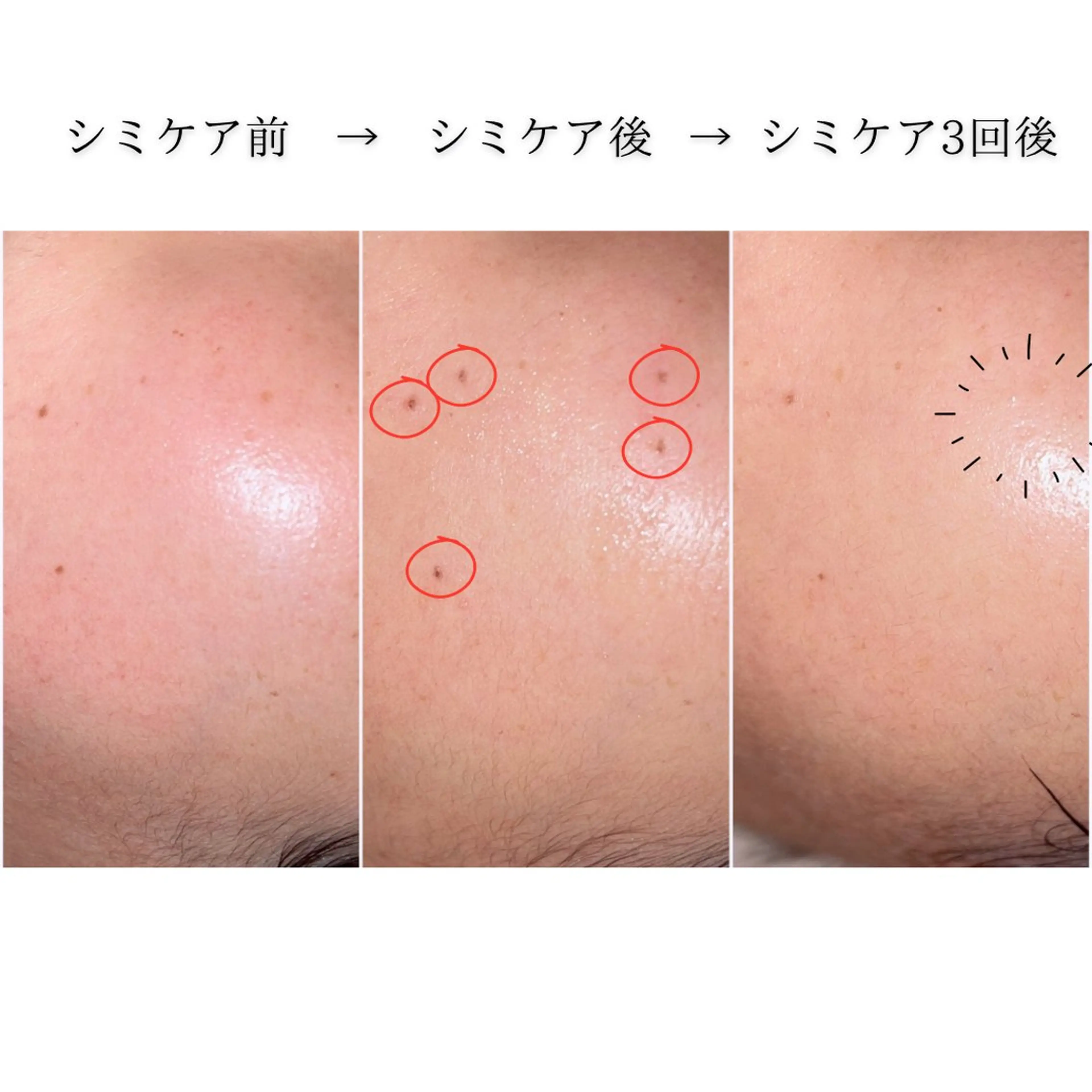 【平日限定】シミしわ改善・予防ケアお試し2回分※男女OK！の写真