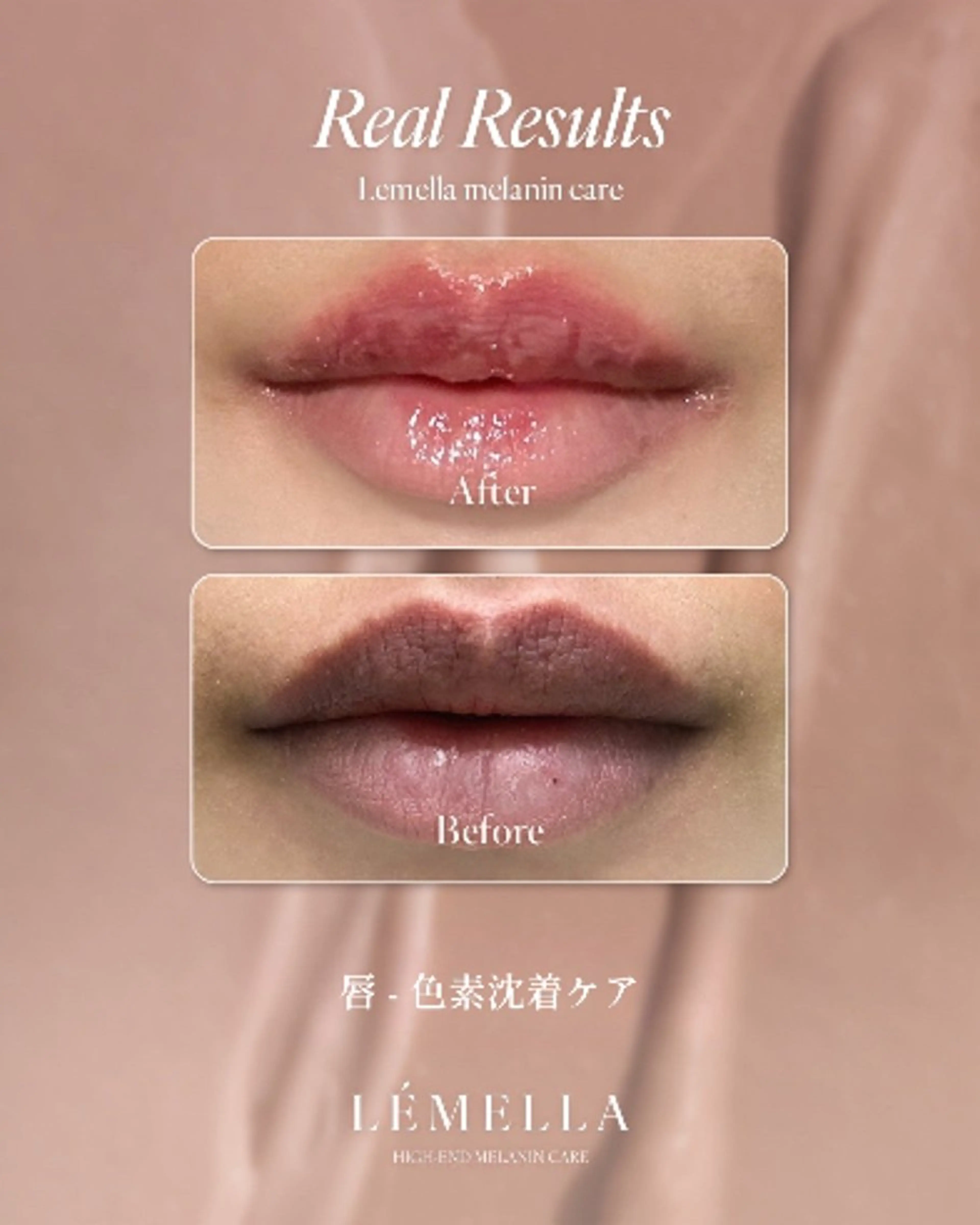 韓国No.1シェア【メラニン除去ケア】 リップ＊アフタークリーム1個(¥17,000)付きの写真