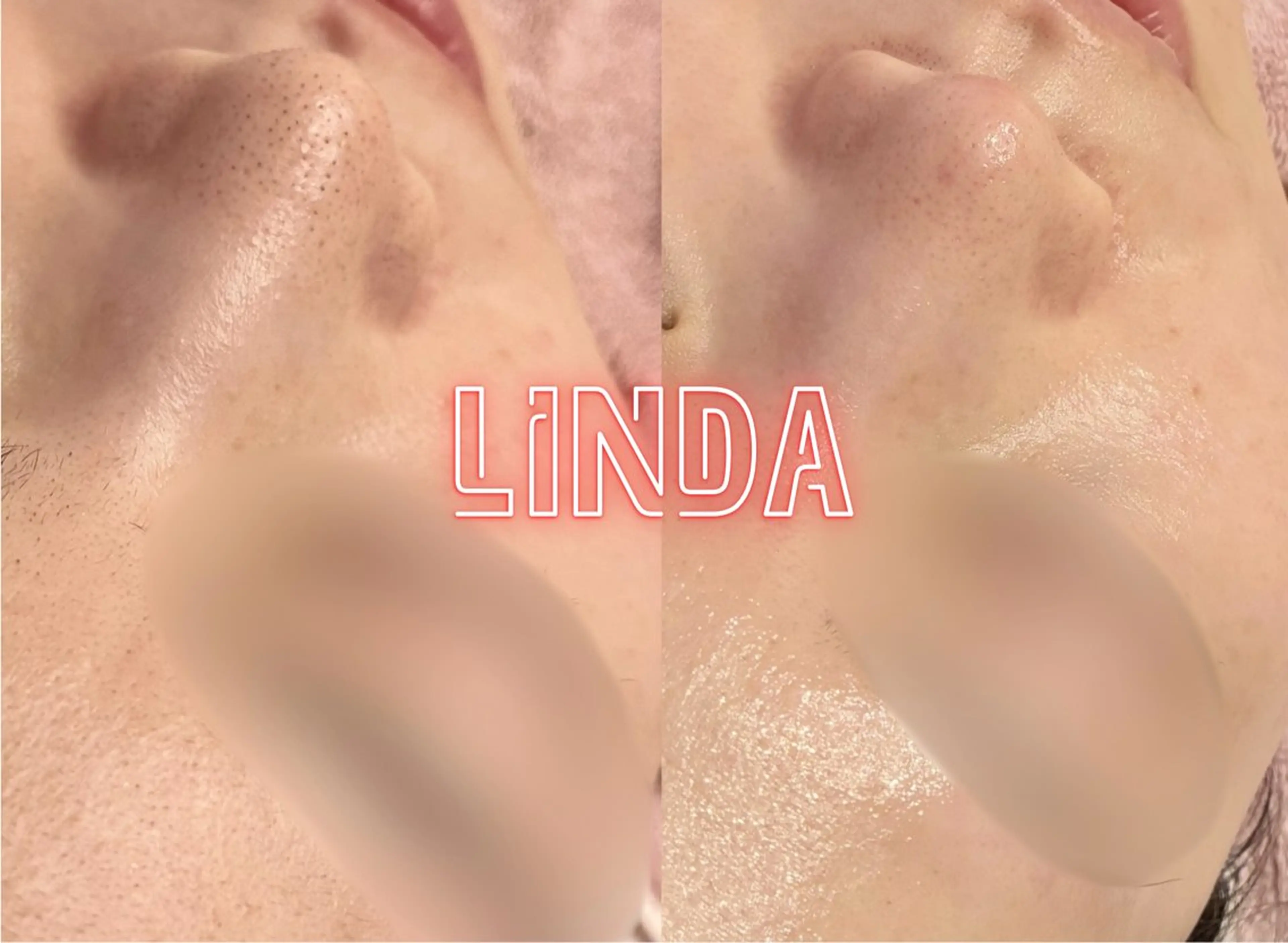 エステ アイラッシュ&エステサロンLinda西宮所属・小顔&毛穴・肌質改善 LINDA西宮 AIのエステ・リラクイメージ