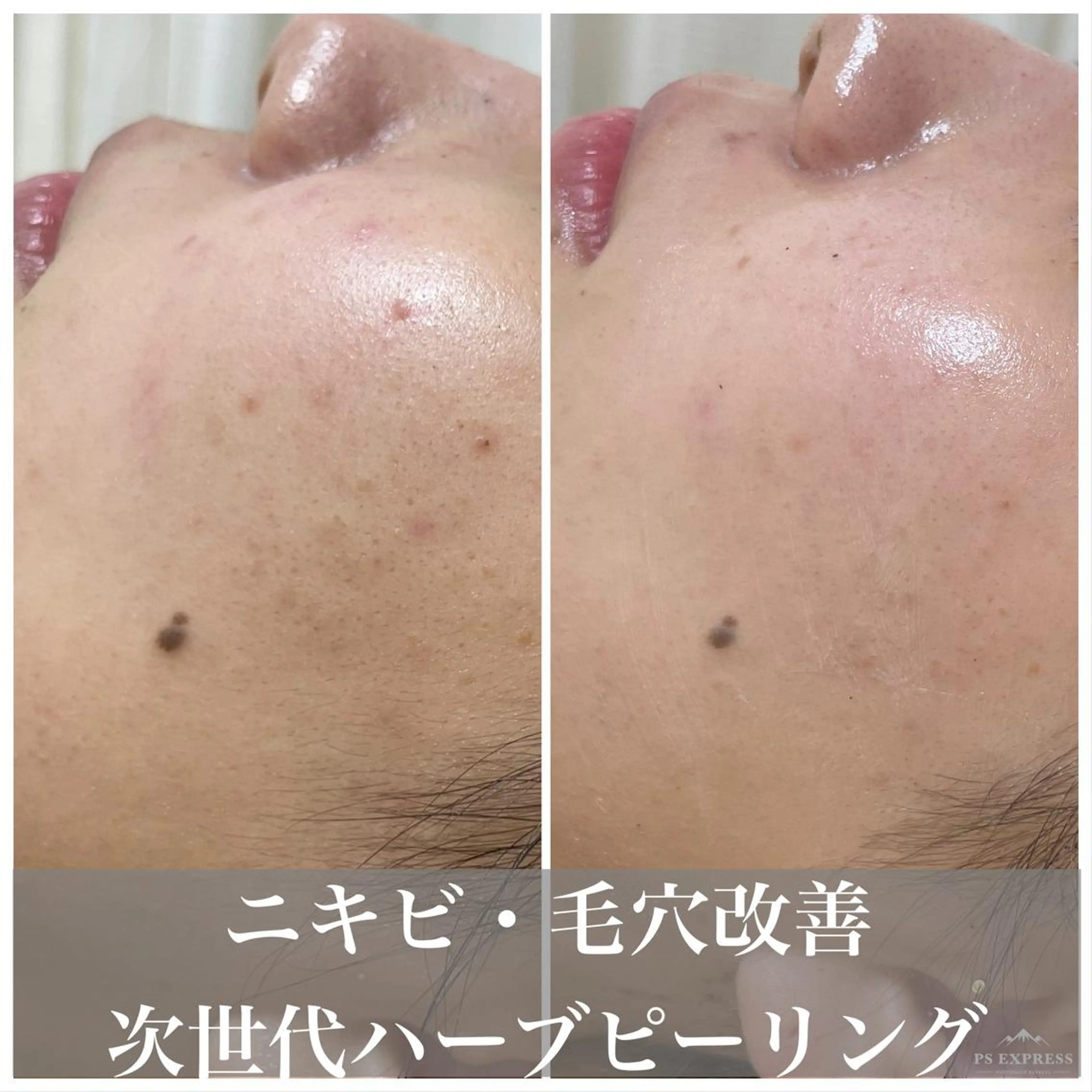 マツエク・マツパ エステ ニキビ・毛穴改善 🌿ハーブピーリングのエステ・リラクイメージ