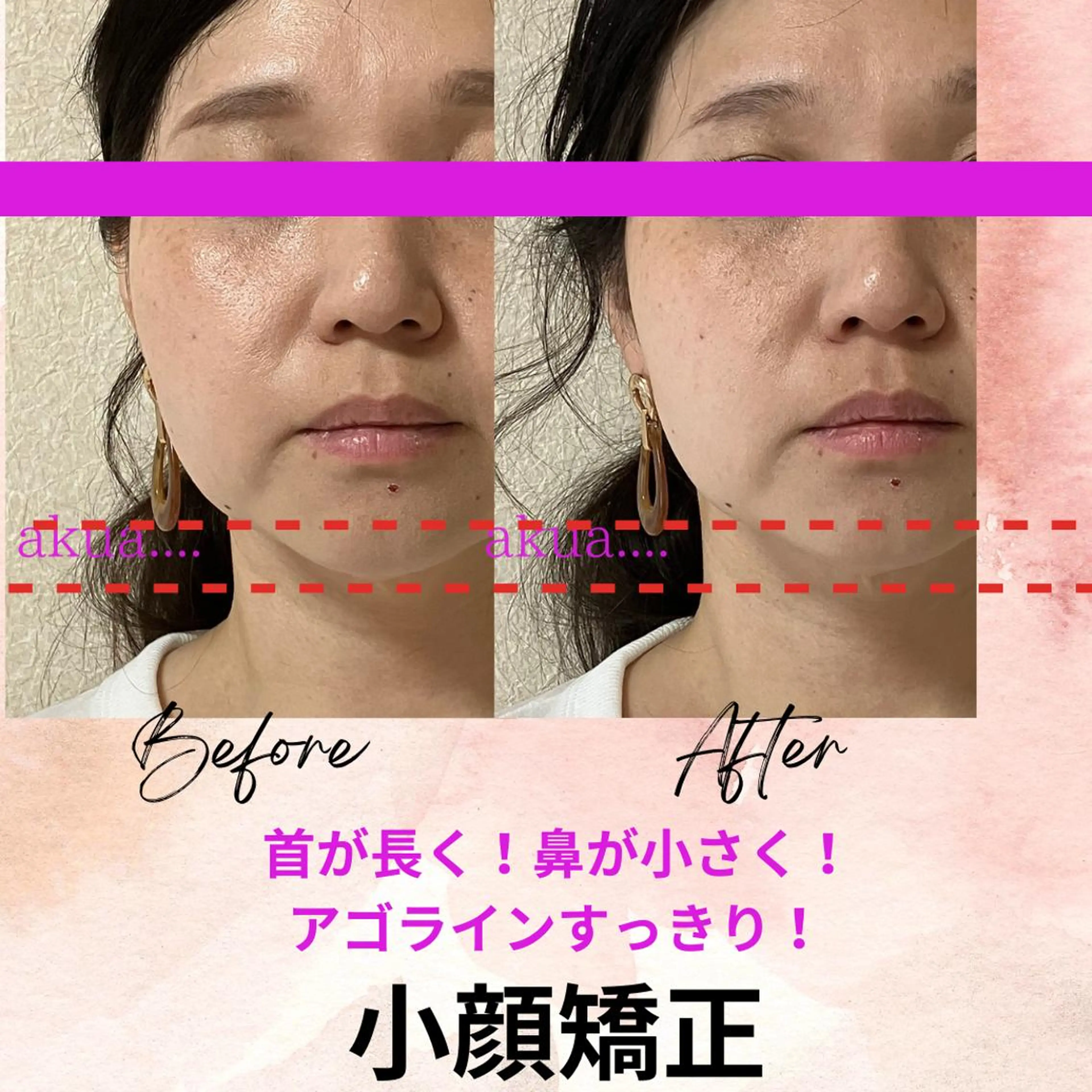 【効果重視】歯のセルフホワイトニング＆痛くない小顔矯正の美顔セット！！の写真