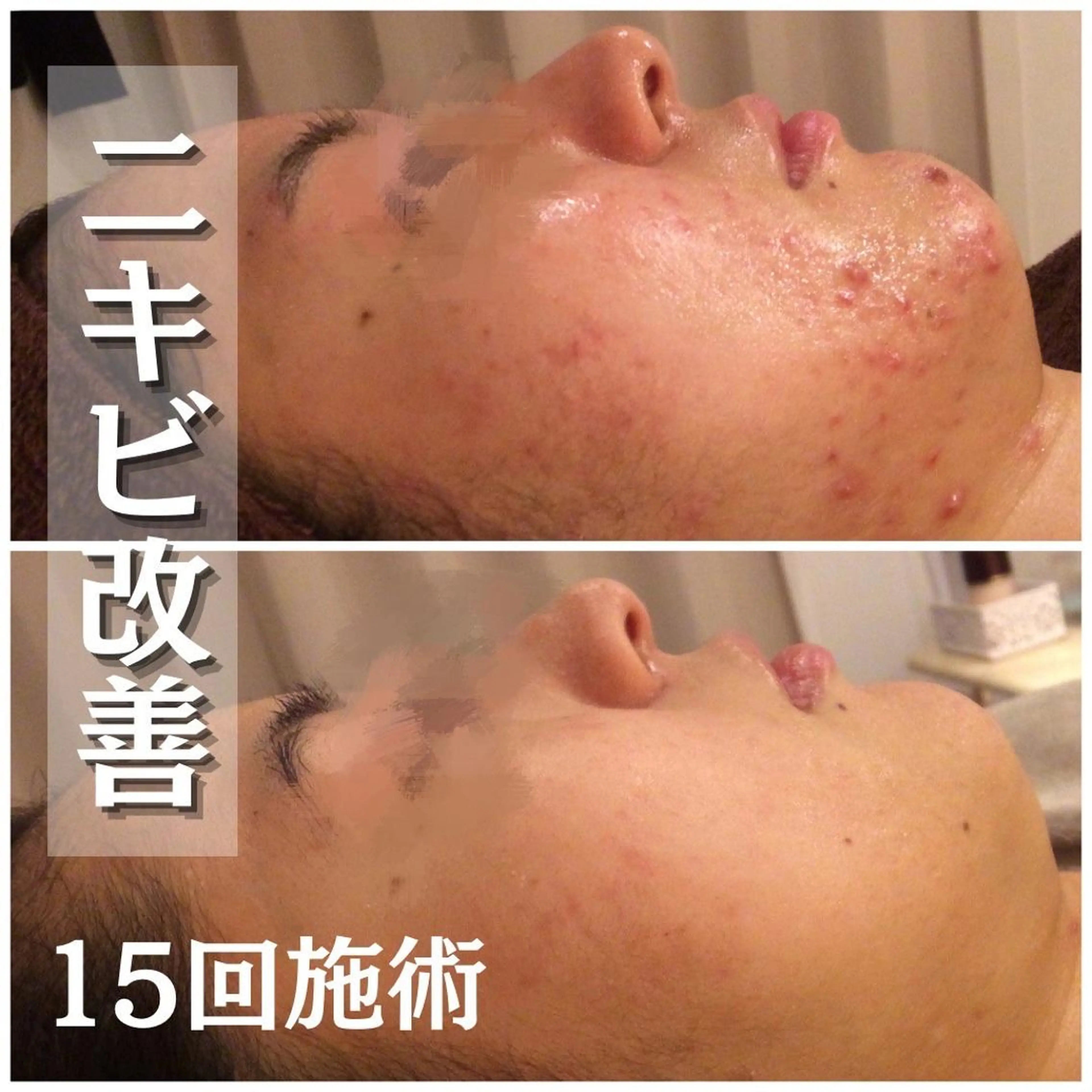 都内で出来る肌管理！ 最短ニキビ改善のエステ・リラクイメージ