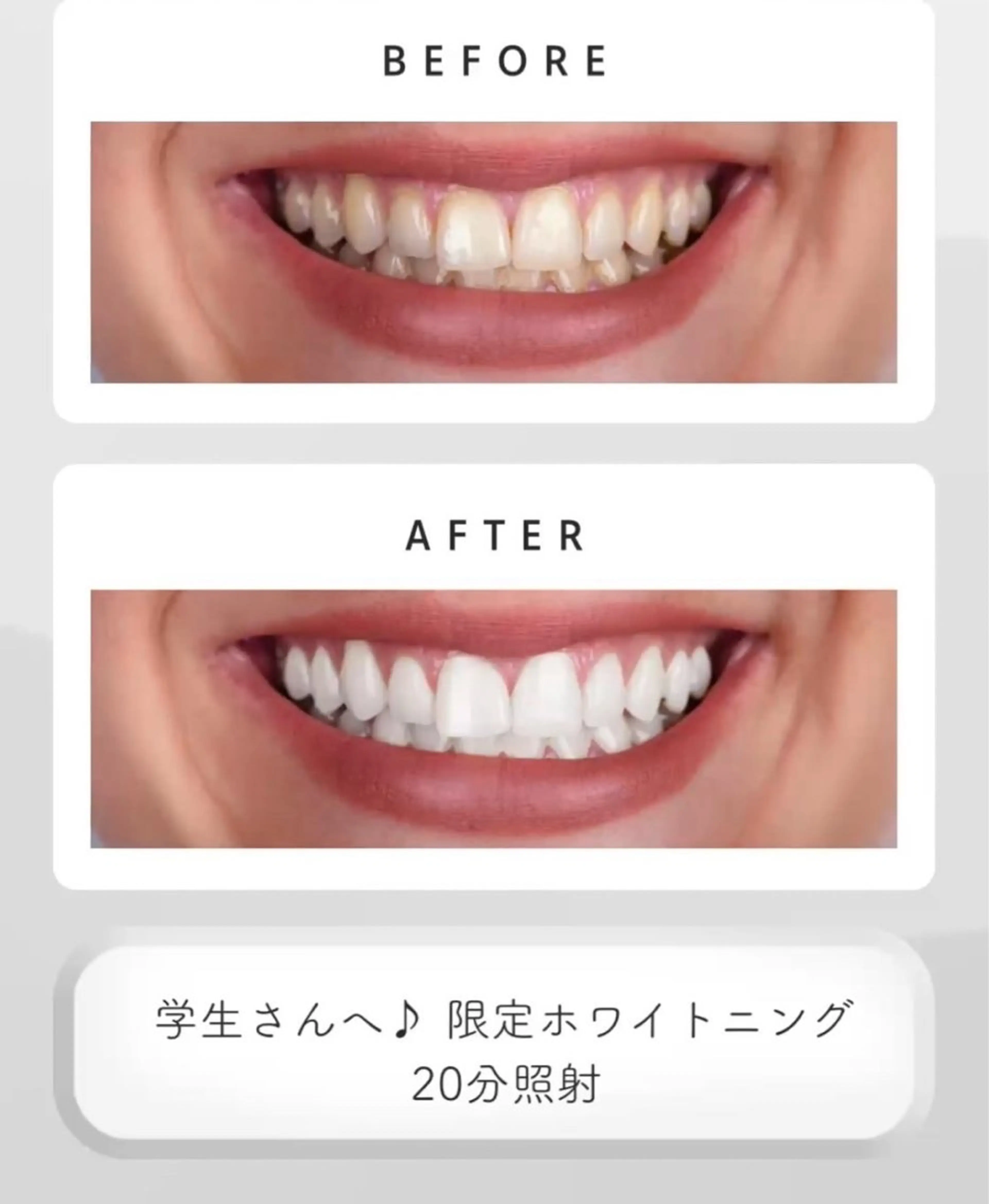 アイブロウ33🦷久留米店💫所属・ふみな セルフホワイトニングのその他イメージ