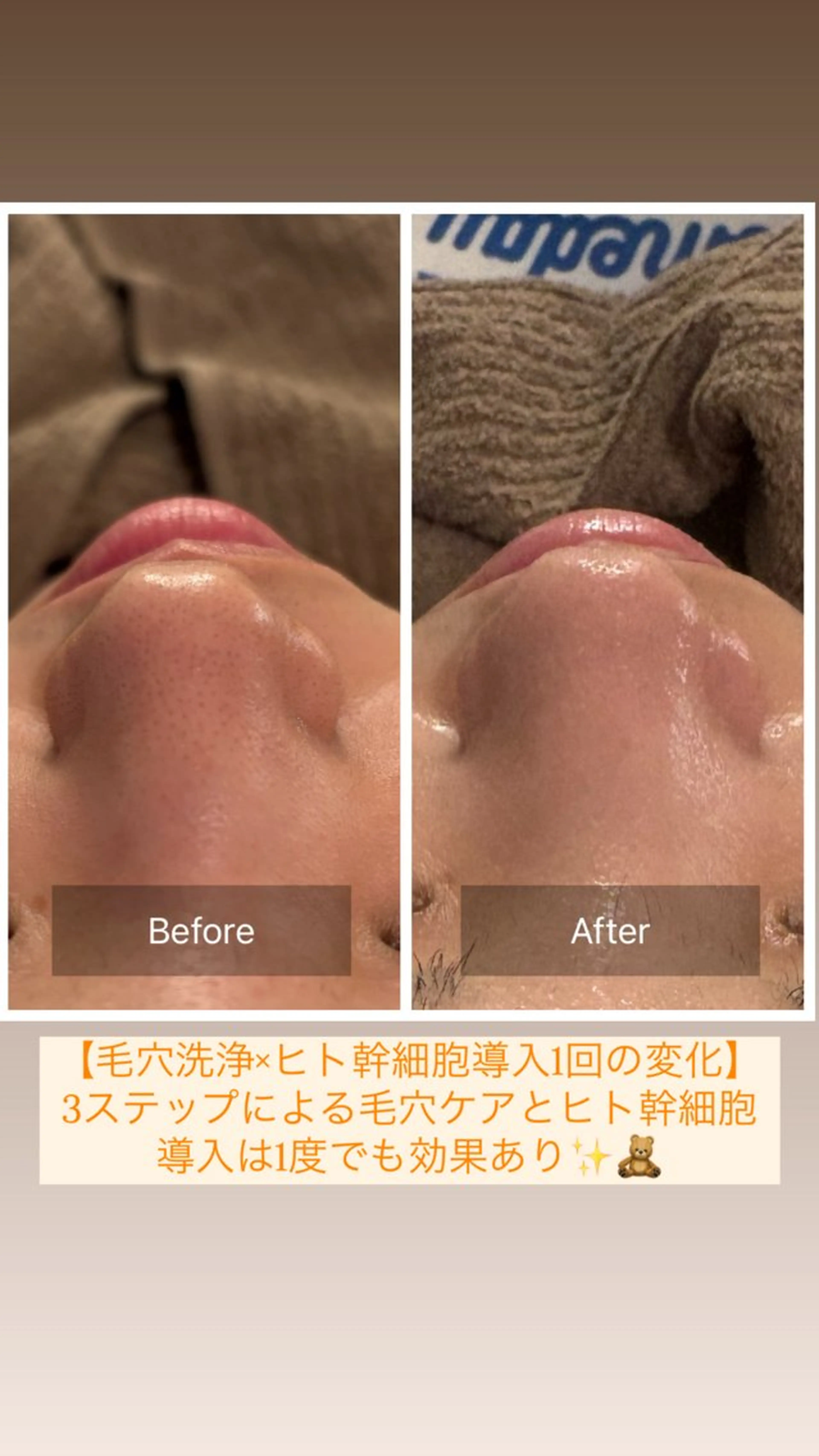 【毛穴特化】 3STEP毛穴洗浄✕45％ヒト幹細胞導入✕肌質別パック70分の写真