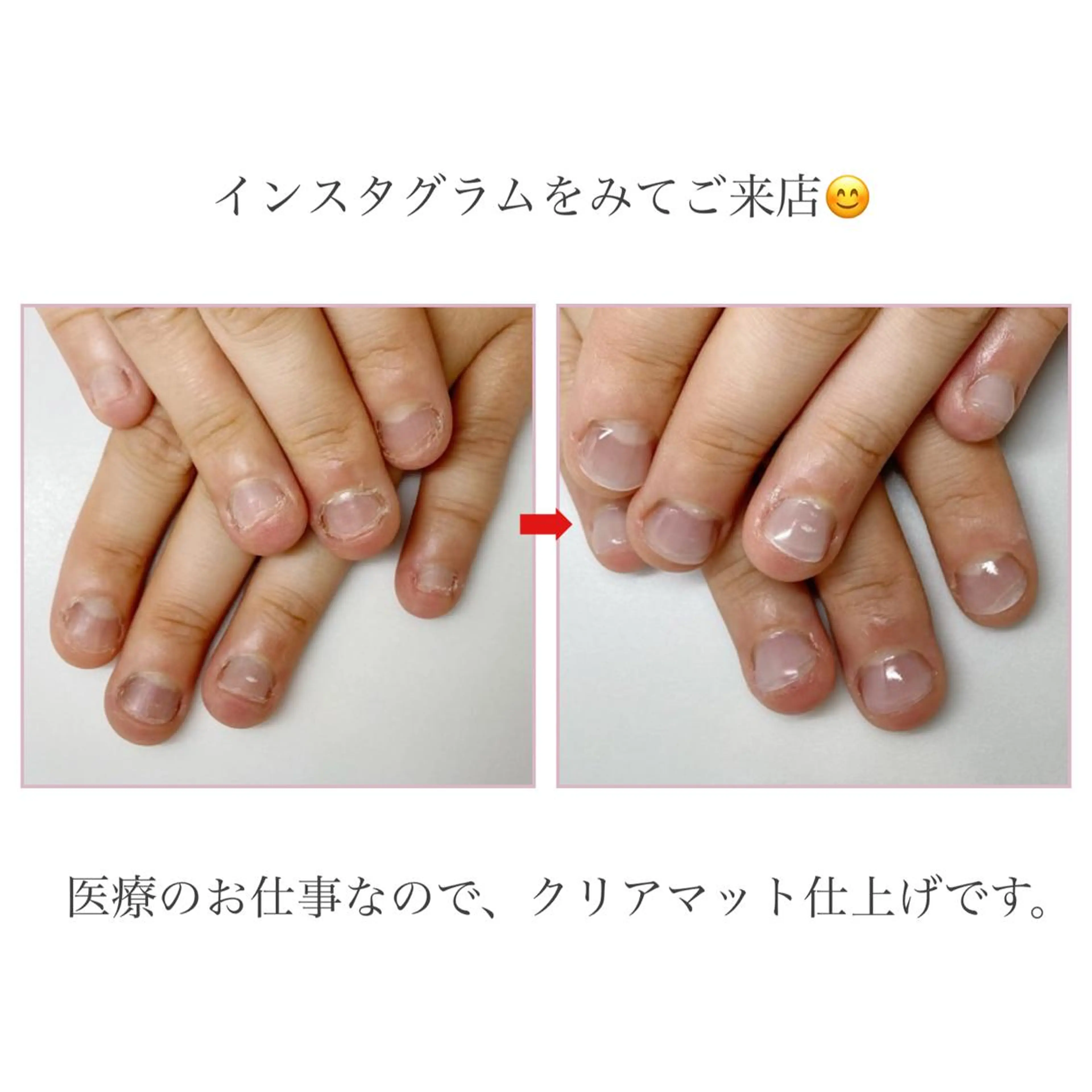 【ネイルNGなお仕事の方🍀】深爪矯正長さだし10本＋クリア仕上げ（マット可）の写真