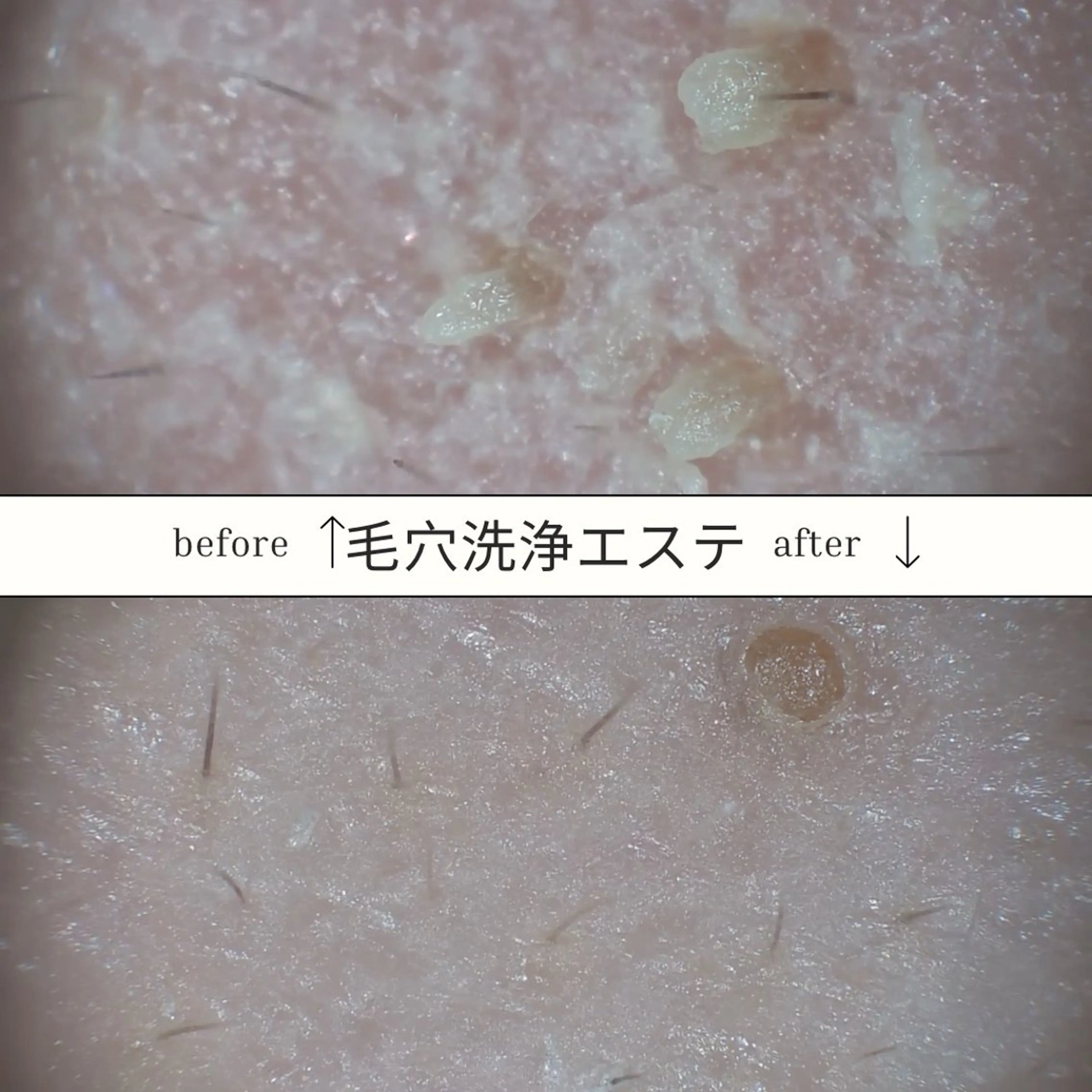 【メンズフェイシャル】皮脂ゴッソリ★毛穴洗浄 ヘッドスパ付の写真