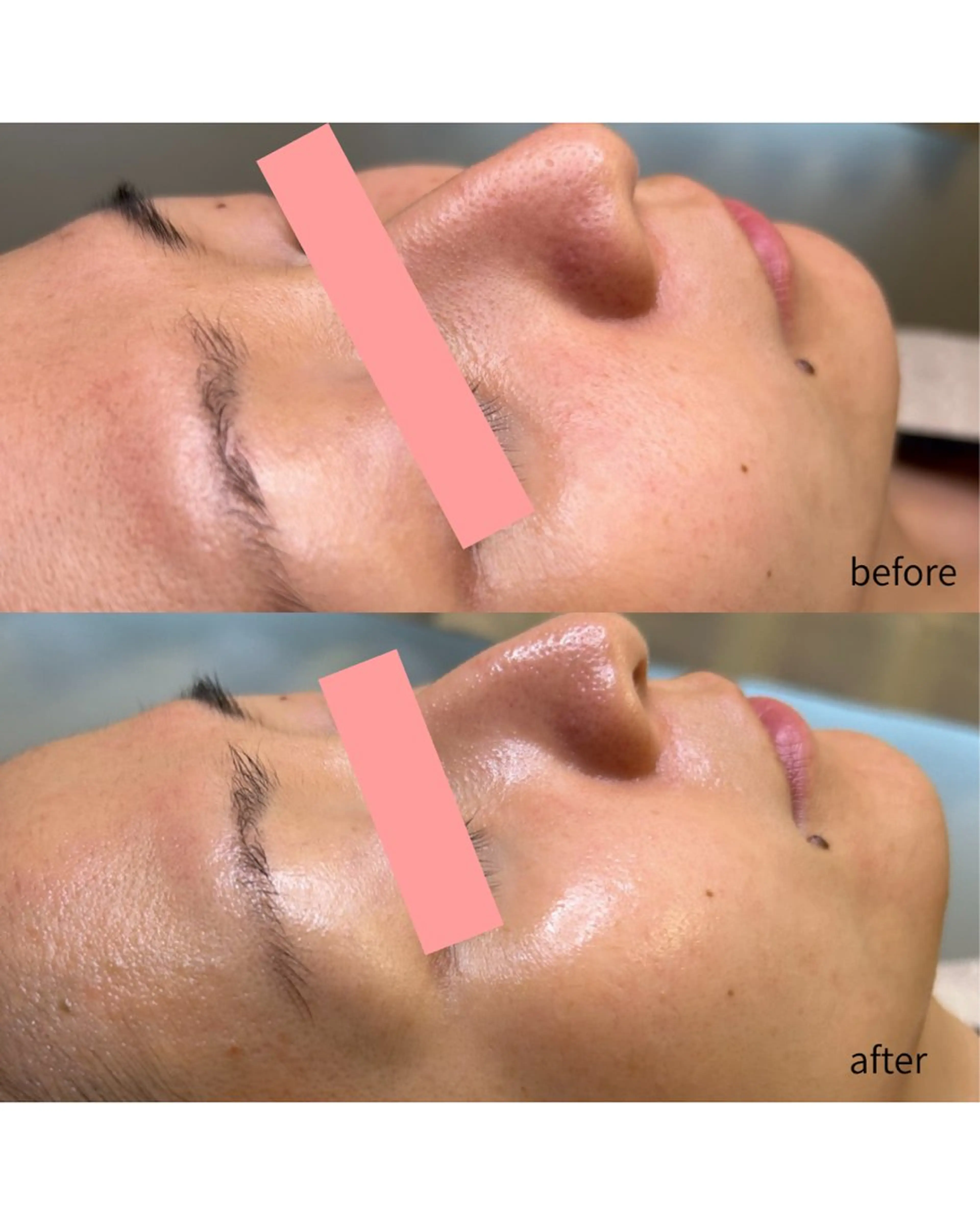 フラワーハーブピーリングの写真