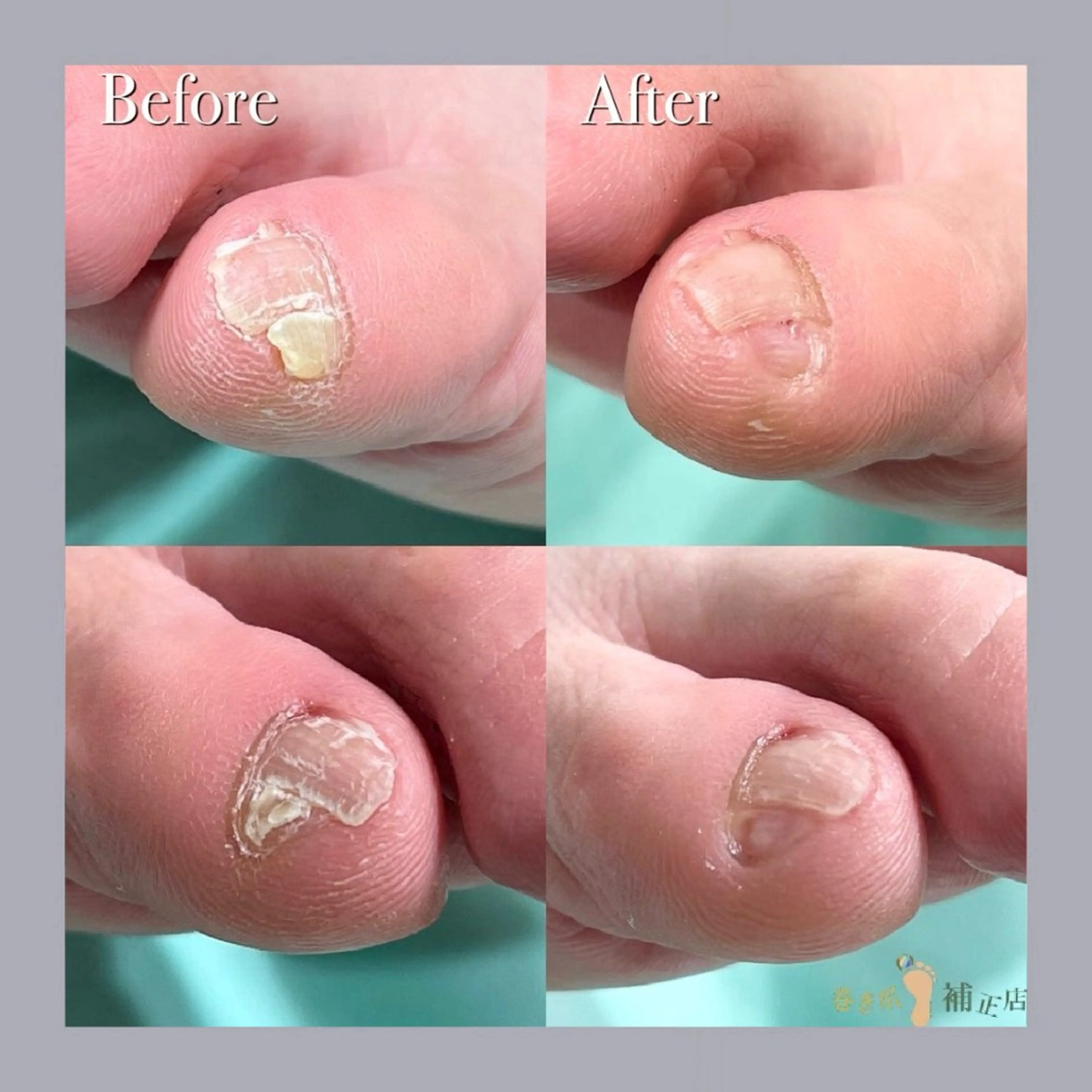 巻き爪補正店 大阪天王寺店のネイルデザイン