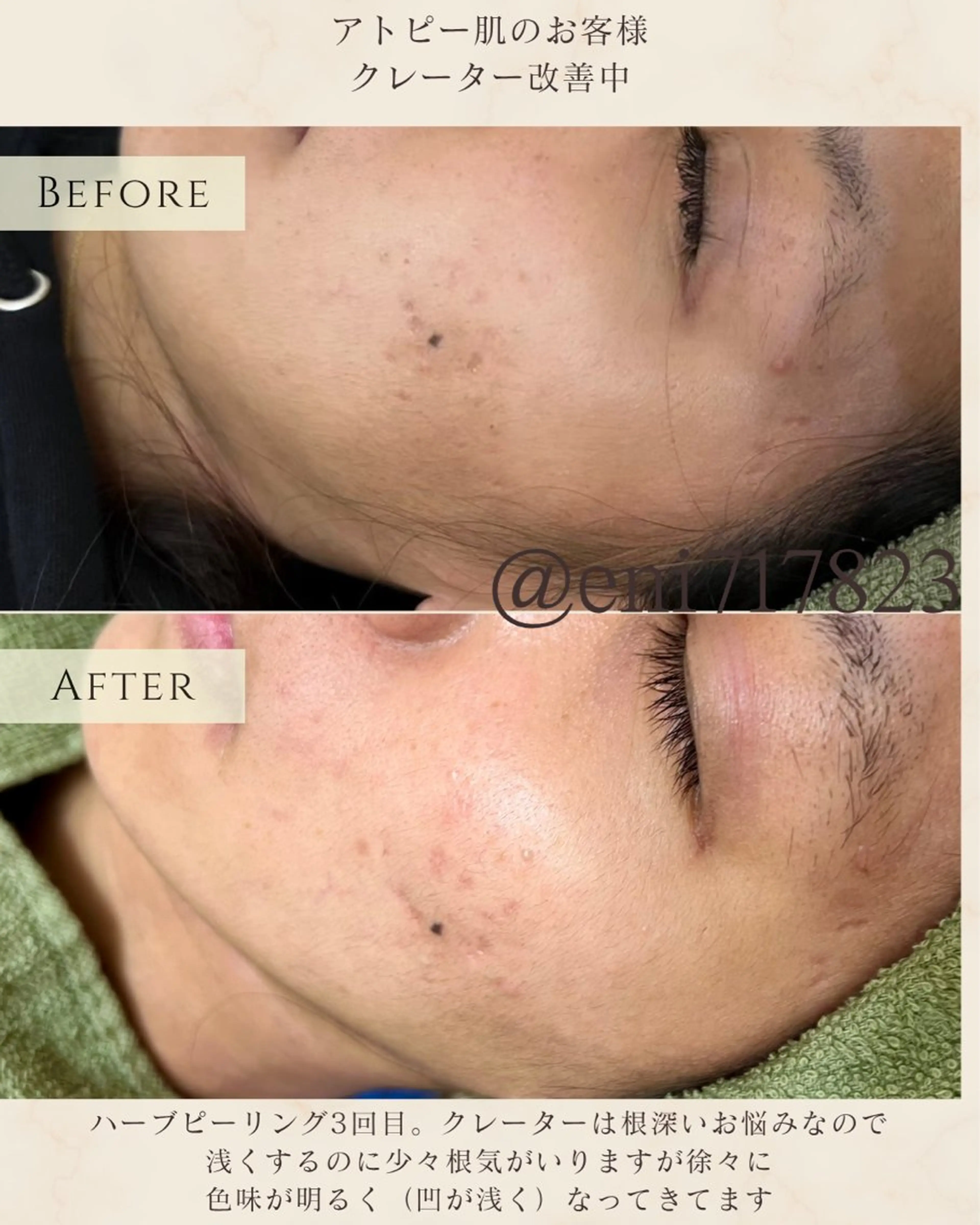 エステ シミ毛穴|眉Wax THE  flowのエステ・リラクイメージ