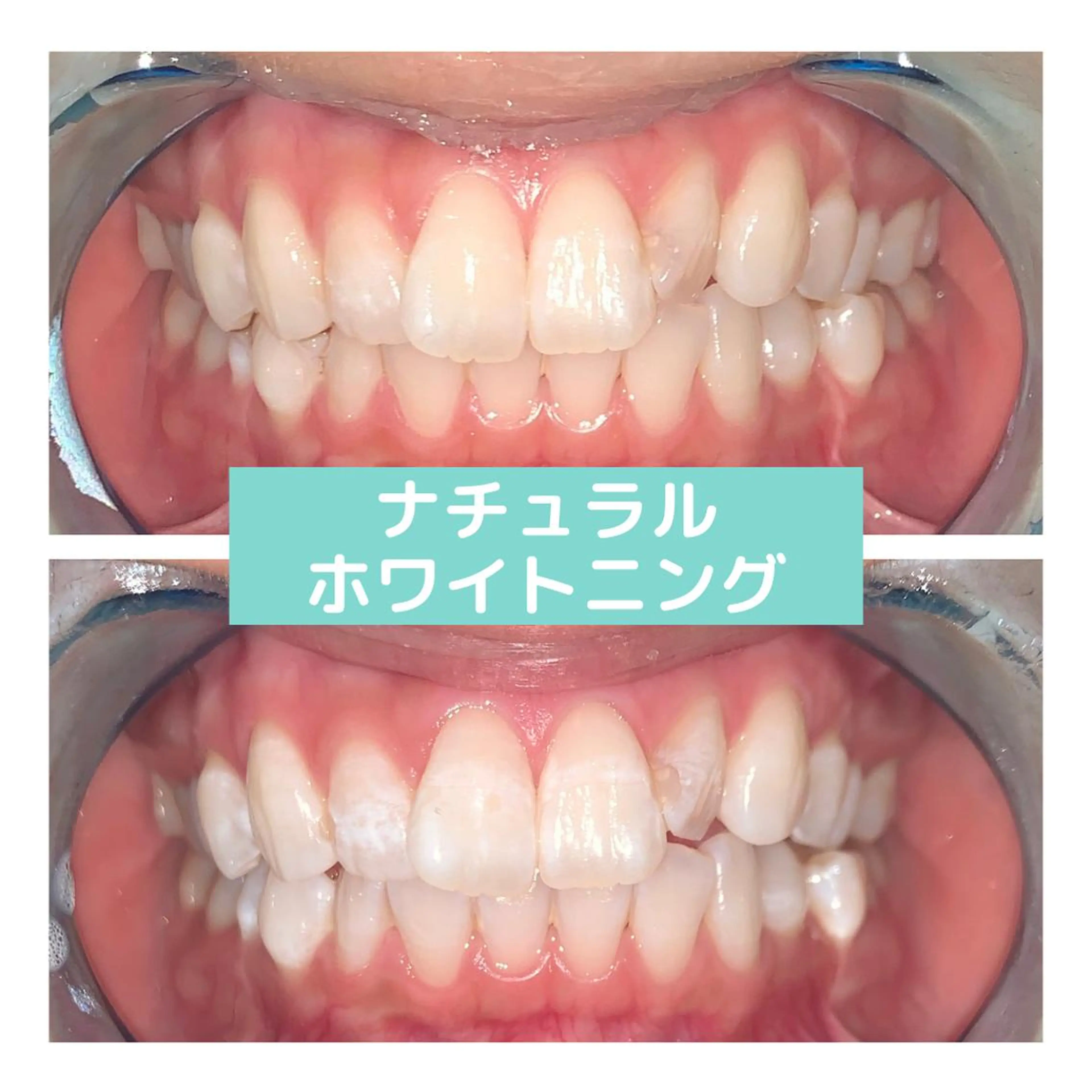 その他 ホワイトニング｜韓国式3D毛穴洗浄 lonhana ﾛﾝﾊﾅ所属・韓国式3D毛穴洗浄 lonhanaのその他イメージ