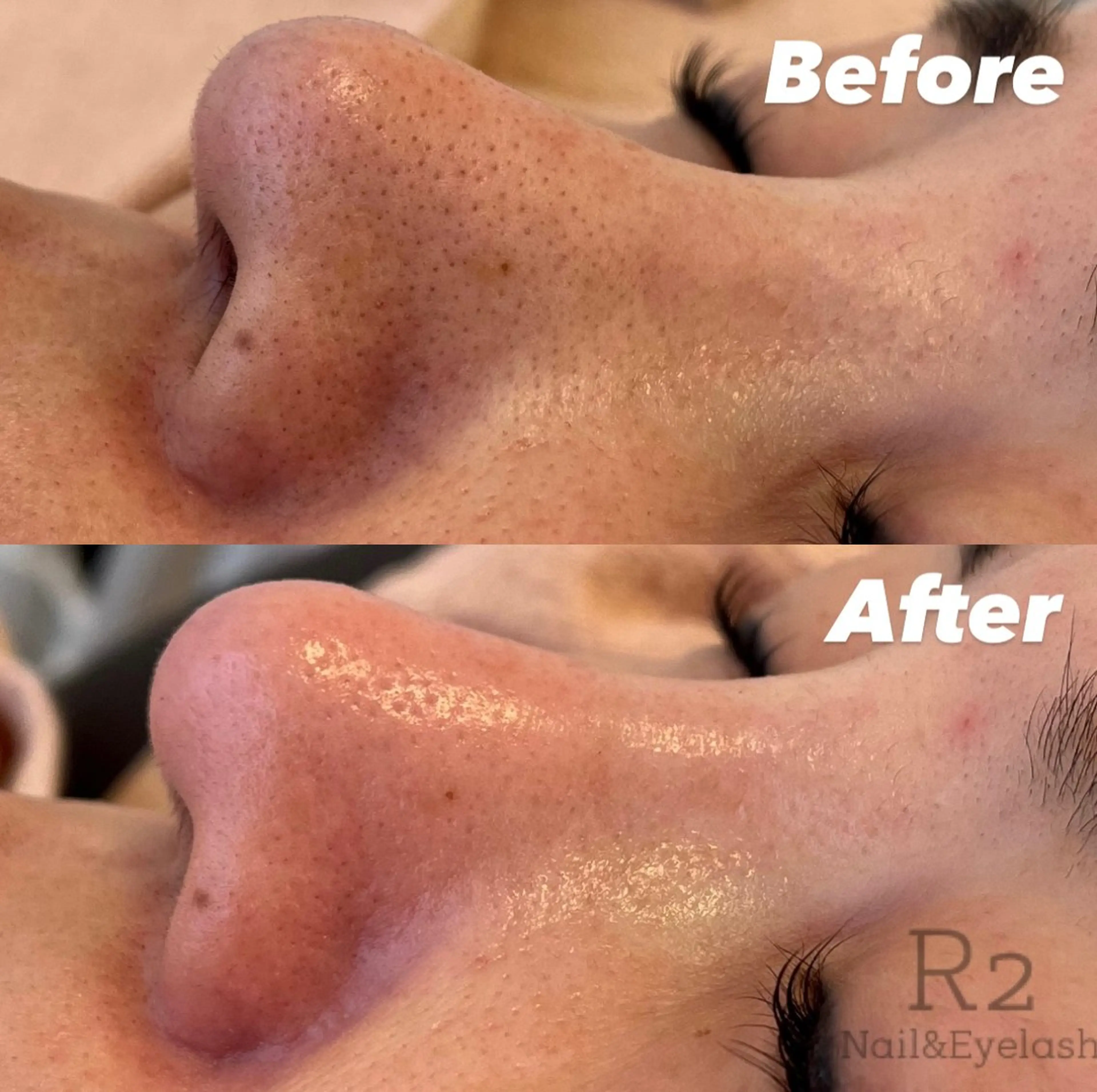 【フェイシャル】毛穴ハイドロピーリング(顔全体コース)¥4500の写真