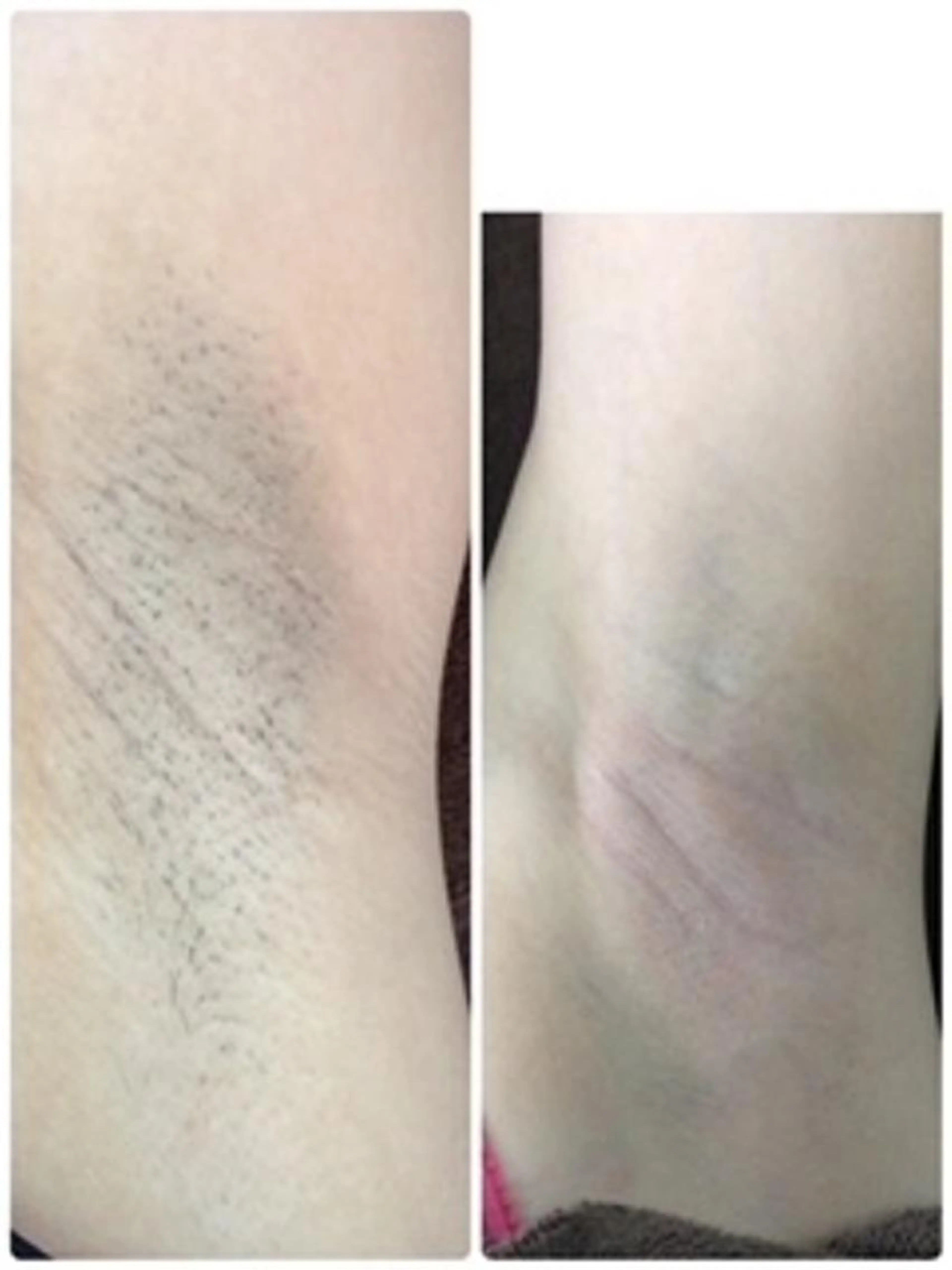 痛くない　わき脱毛　ミニモ限定年内初回価格キャンペーン　￥980 （女性限定）の写真