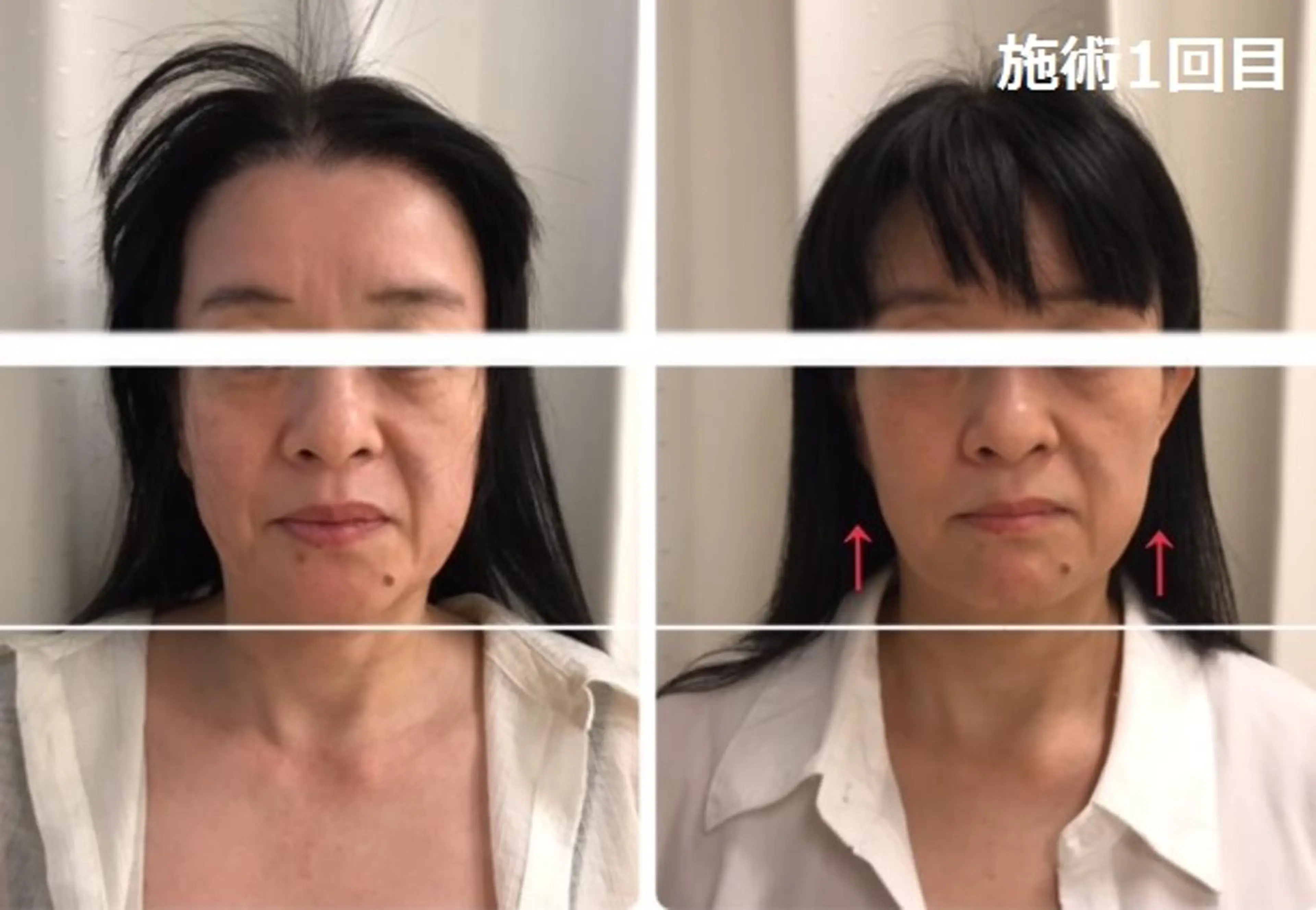 エステ 顔脱毛＆毛穴＆ニキビ 優良№1♪ヒロコ♪のエステ・リラクイメージ