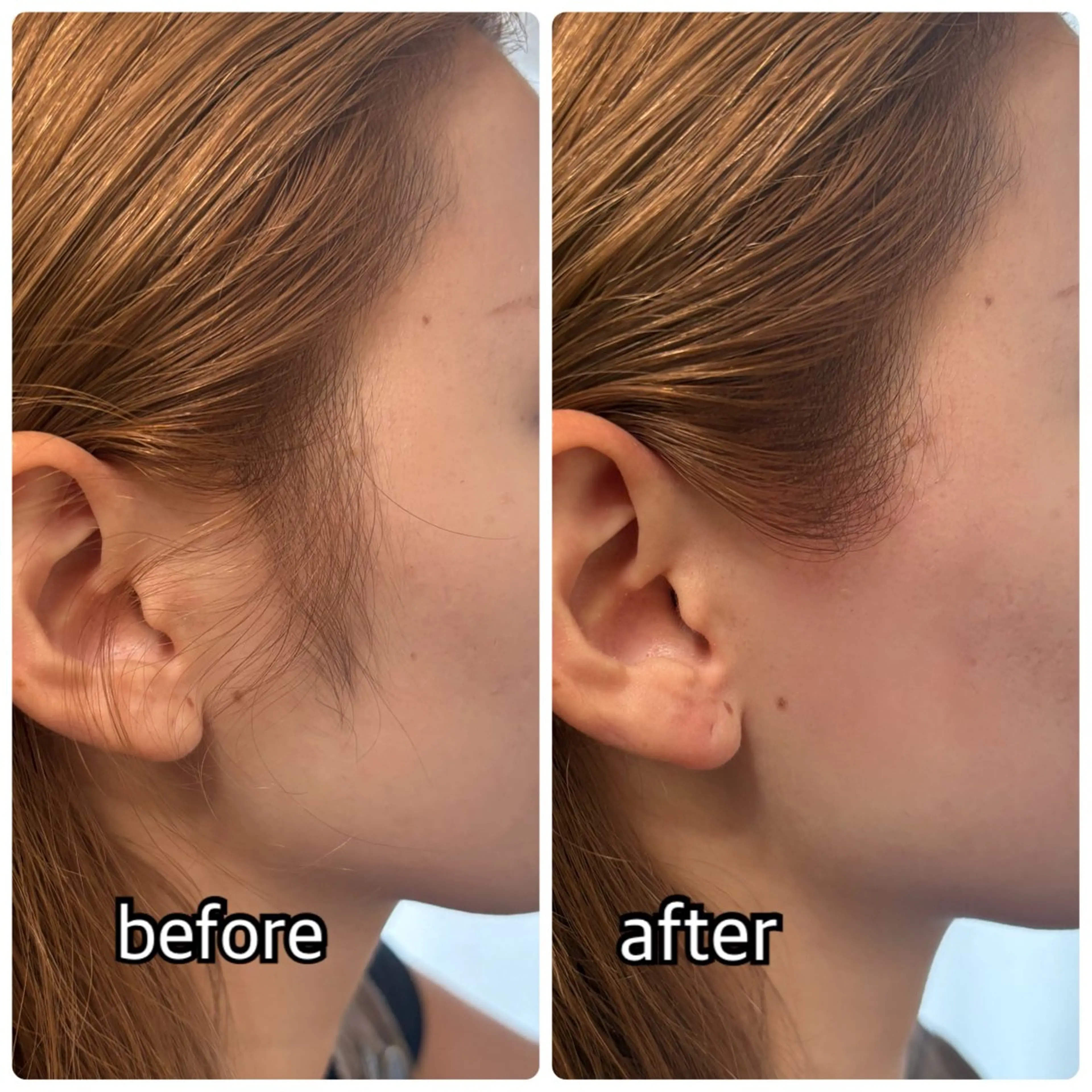 【先着10名】もみあげWax脱毛モニターの写真