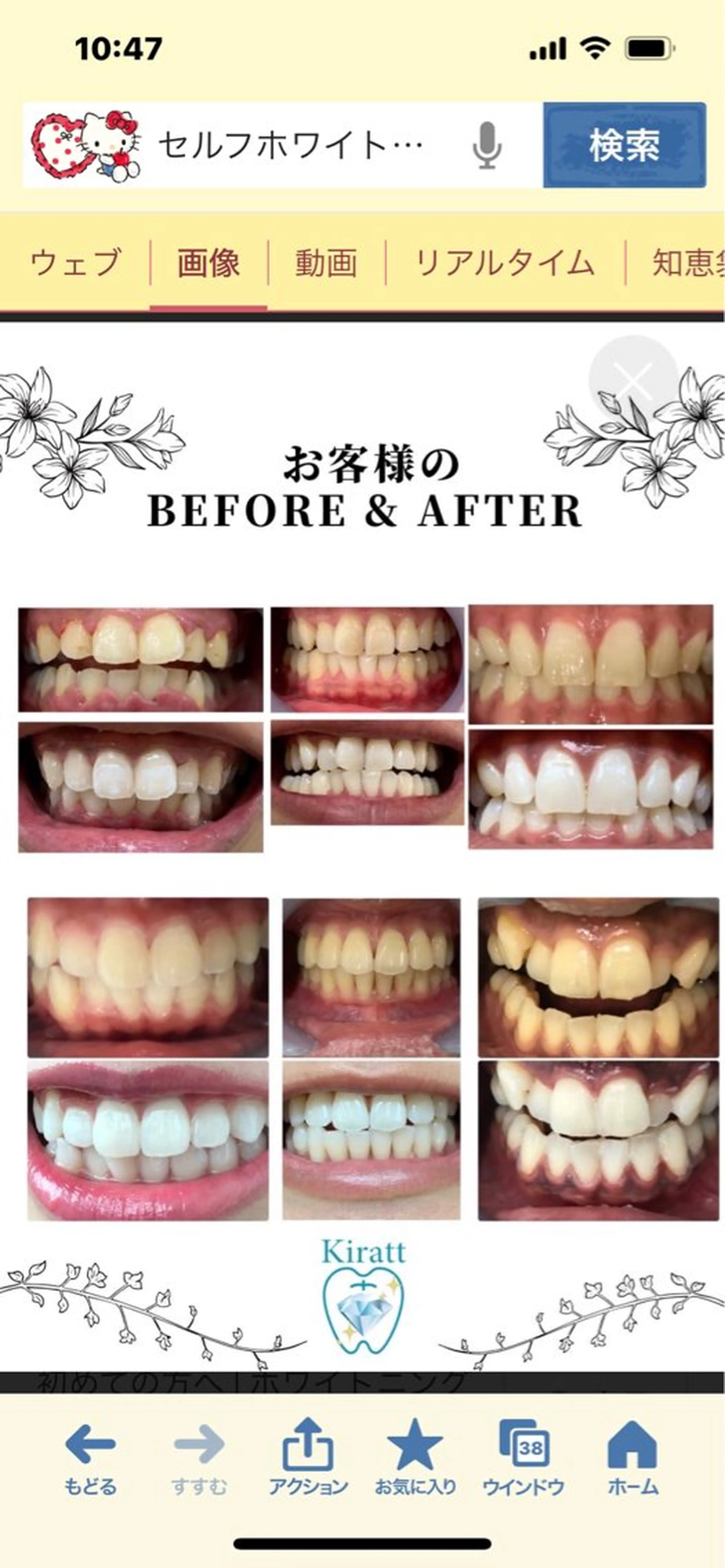 プレミアムコース🦷セルフホワイトニング15分×3回照射！！1回サービス4500円▷▶2400円　　​〜​​〜​現金のみ💸の写真