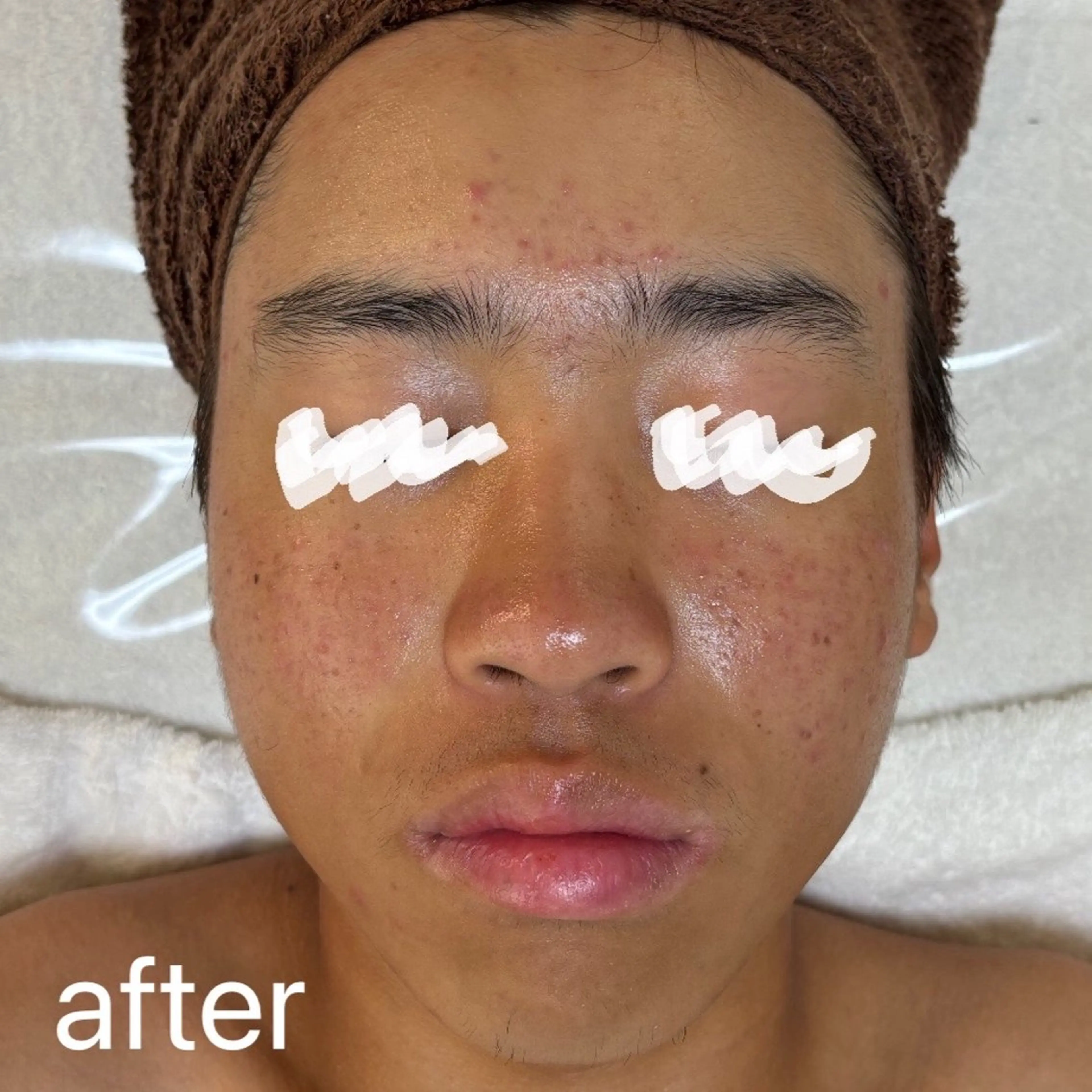 肌質改善|天王寺 For...はるかのエステ・リラクイメージ