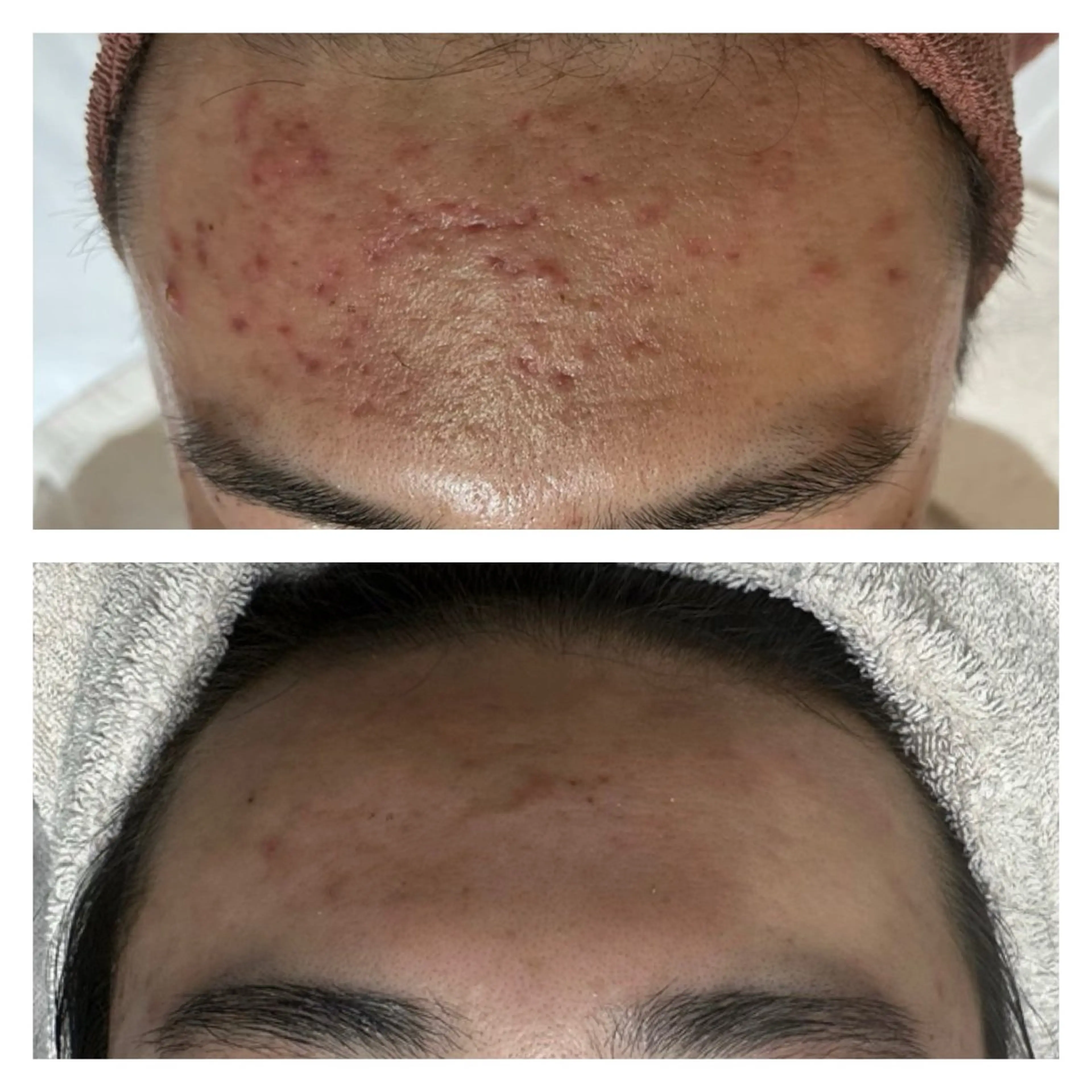 【赤ニキビを強力殺菌‼️】ハイドラ毛穴洗浄+オゾンビーム＋排毒鎮静パック＋LEDケア　※メンズも⭕️の写真