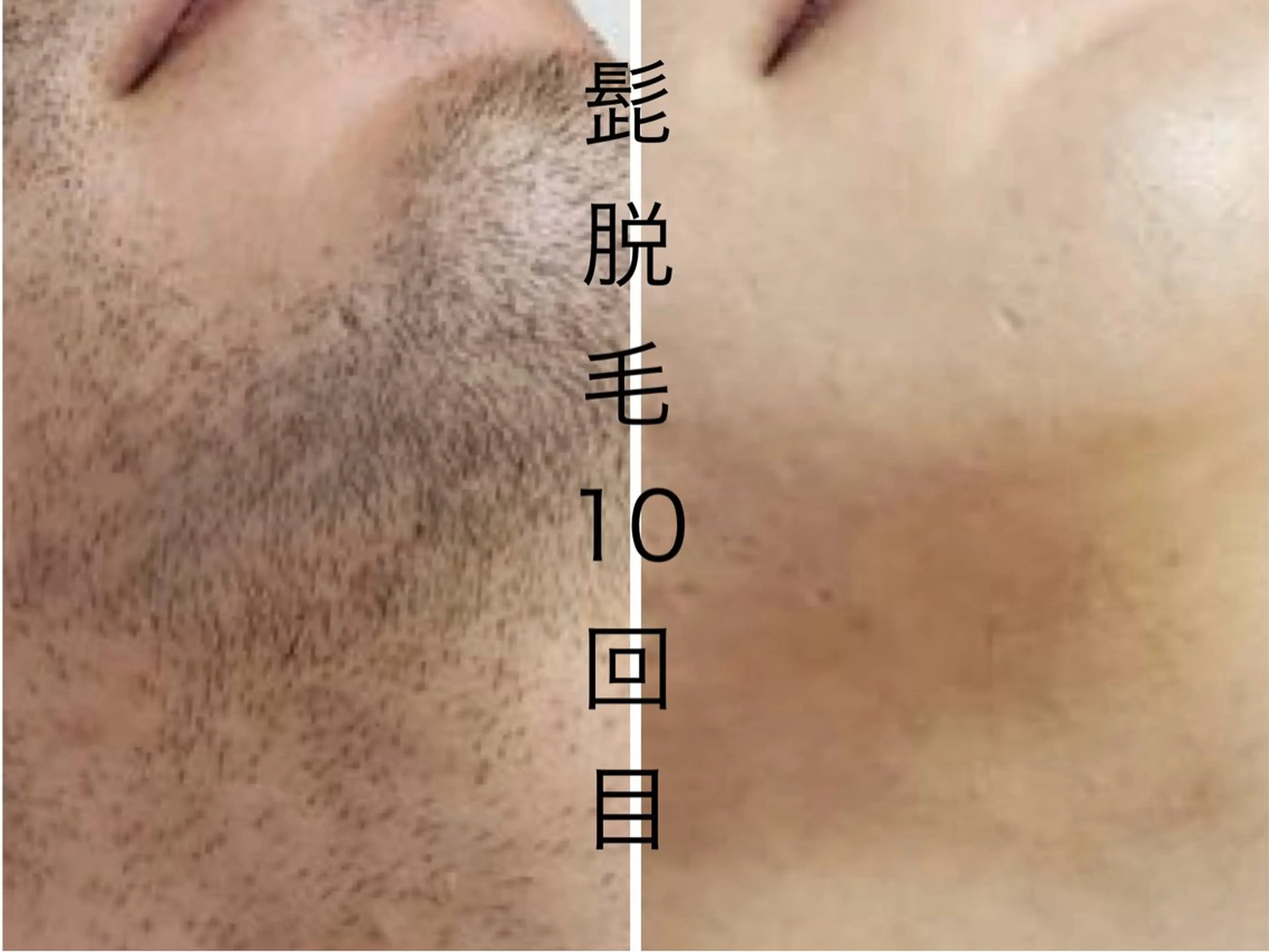 メンズ キッズ 肌管理脱毛ピーリング CDFAkasakaのエステ・リラクイメージ