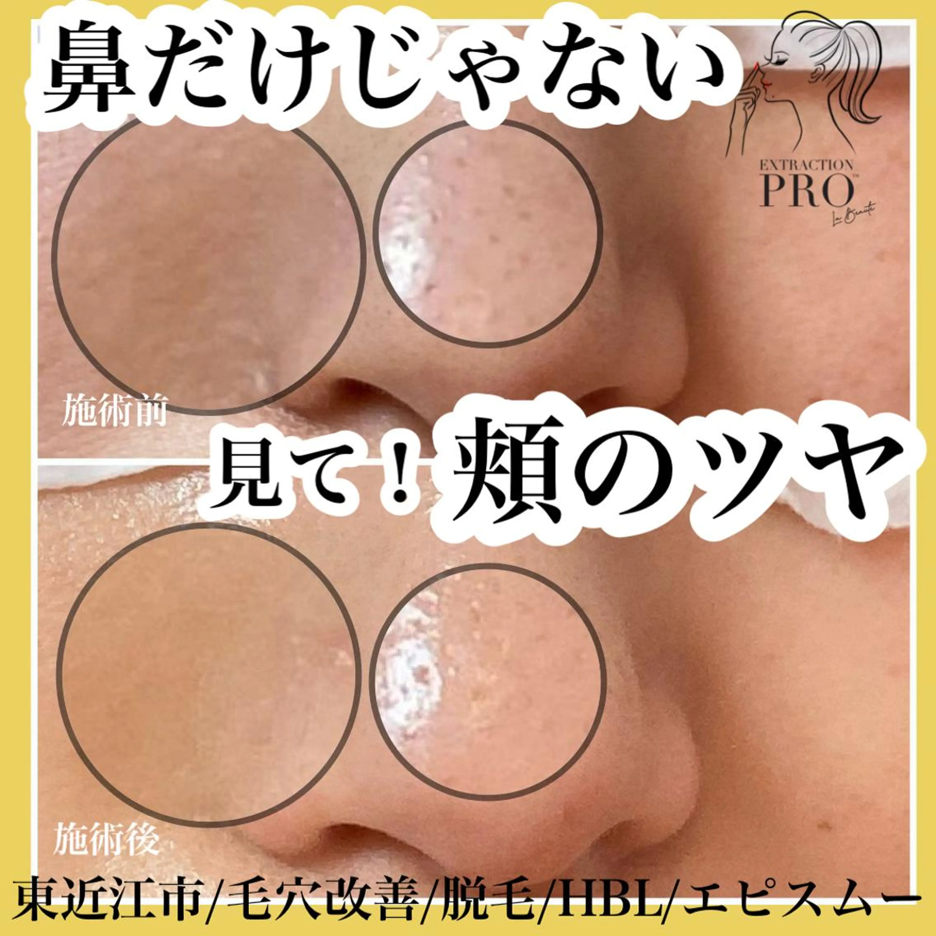 epismoo 脱毛/HBL/毛穴の眉毛・アイブロウイメージ