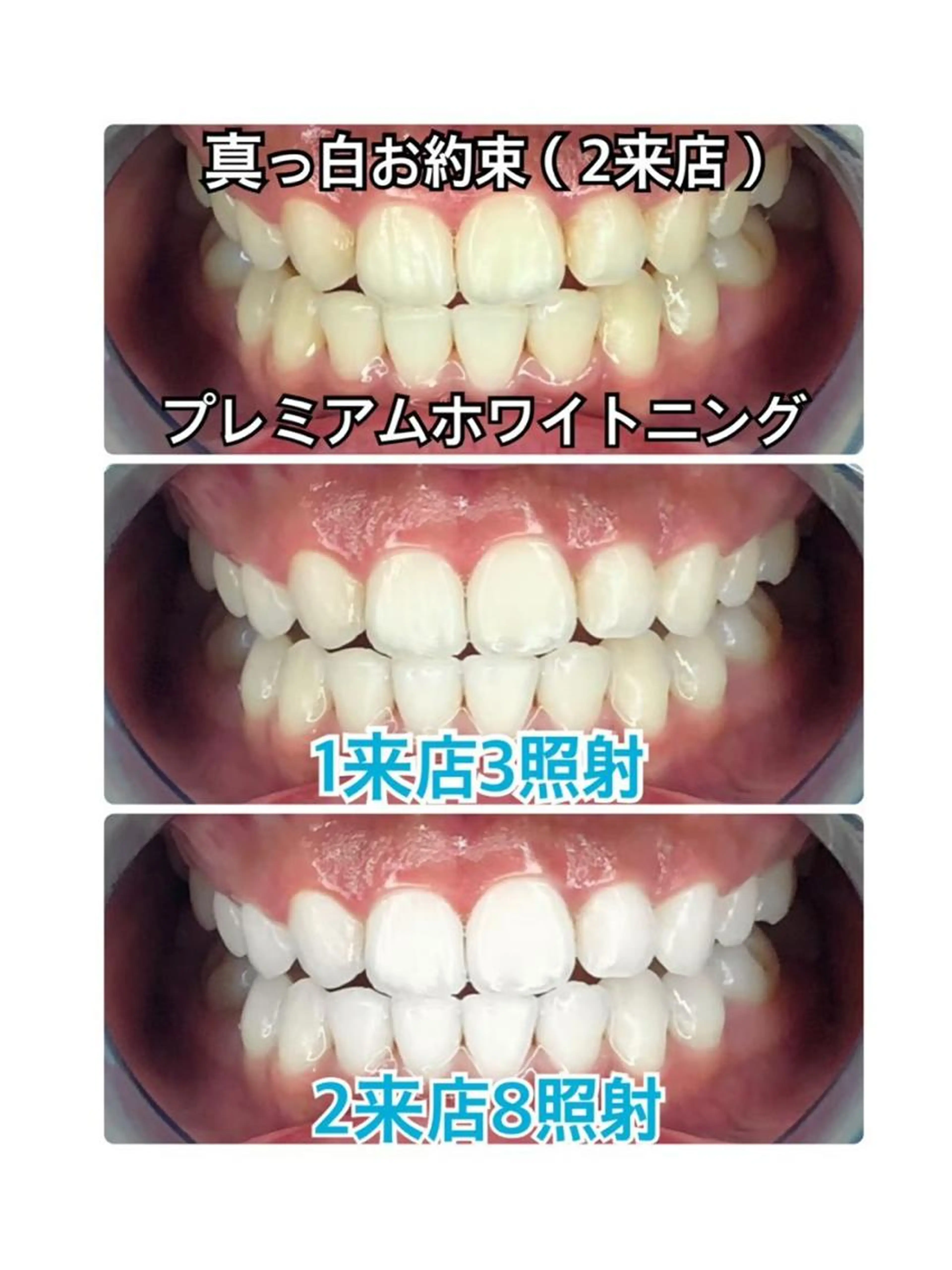 【☆断トツ1番人気☆】プレミアムセルフホワイトニング《2来店メニュー》の写真